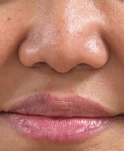 B&A Lip Filler After