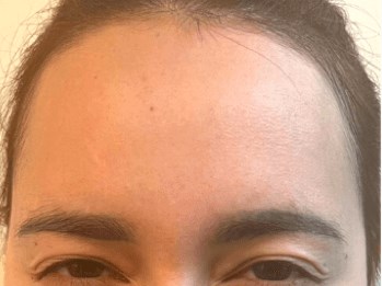 Glabellar Line no more! After