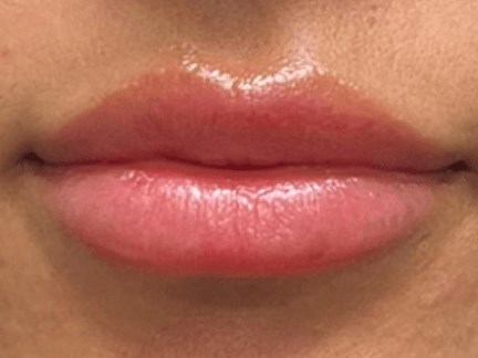 Before & After Lip Filler Before