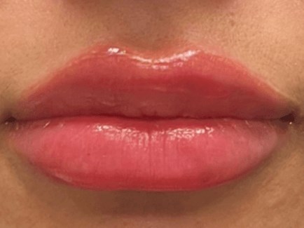Before & After Lip Filler After