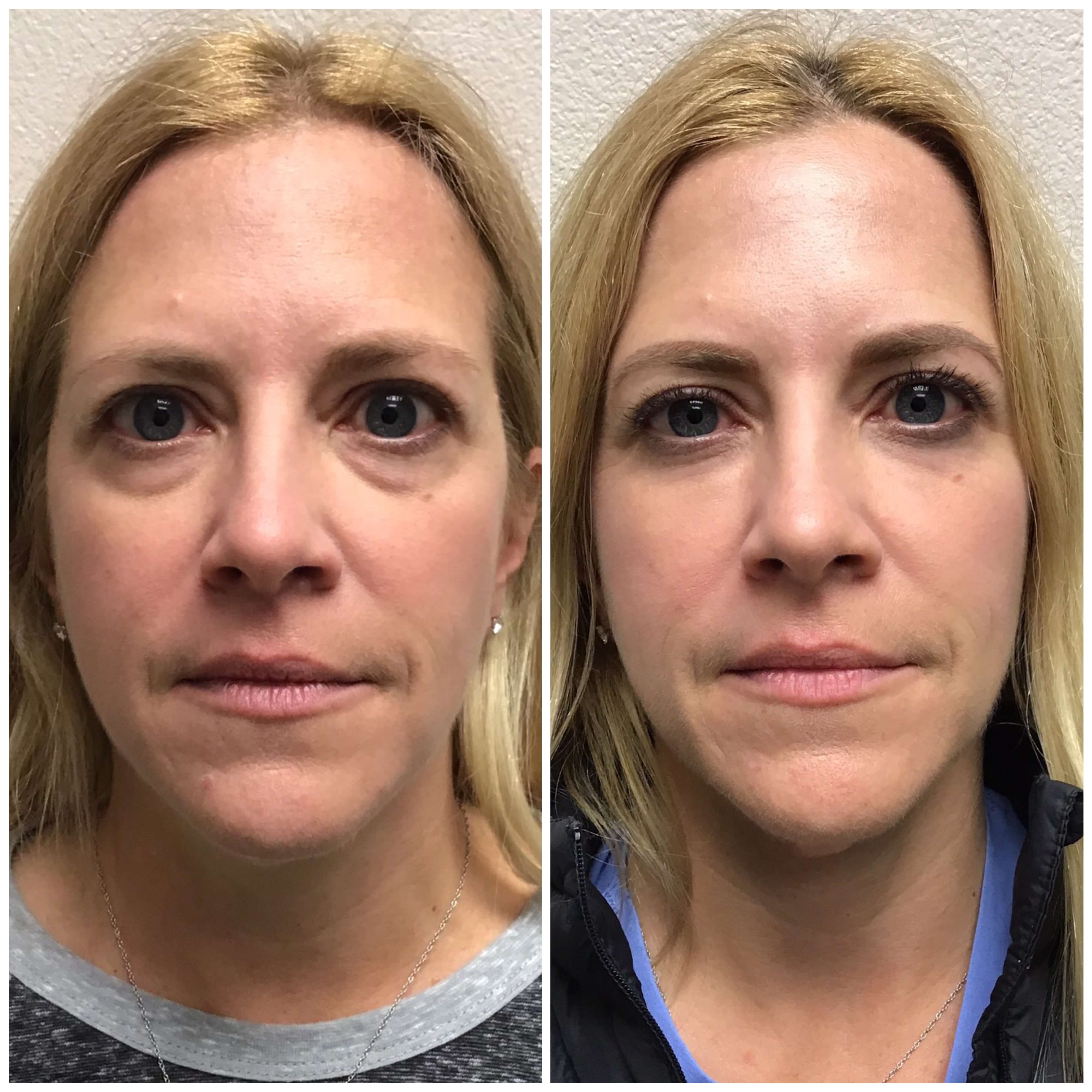 Tear Trough Filler Before