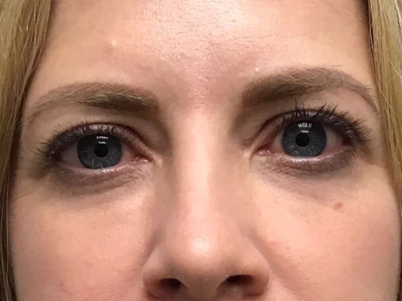 Tear Trough Filler After