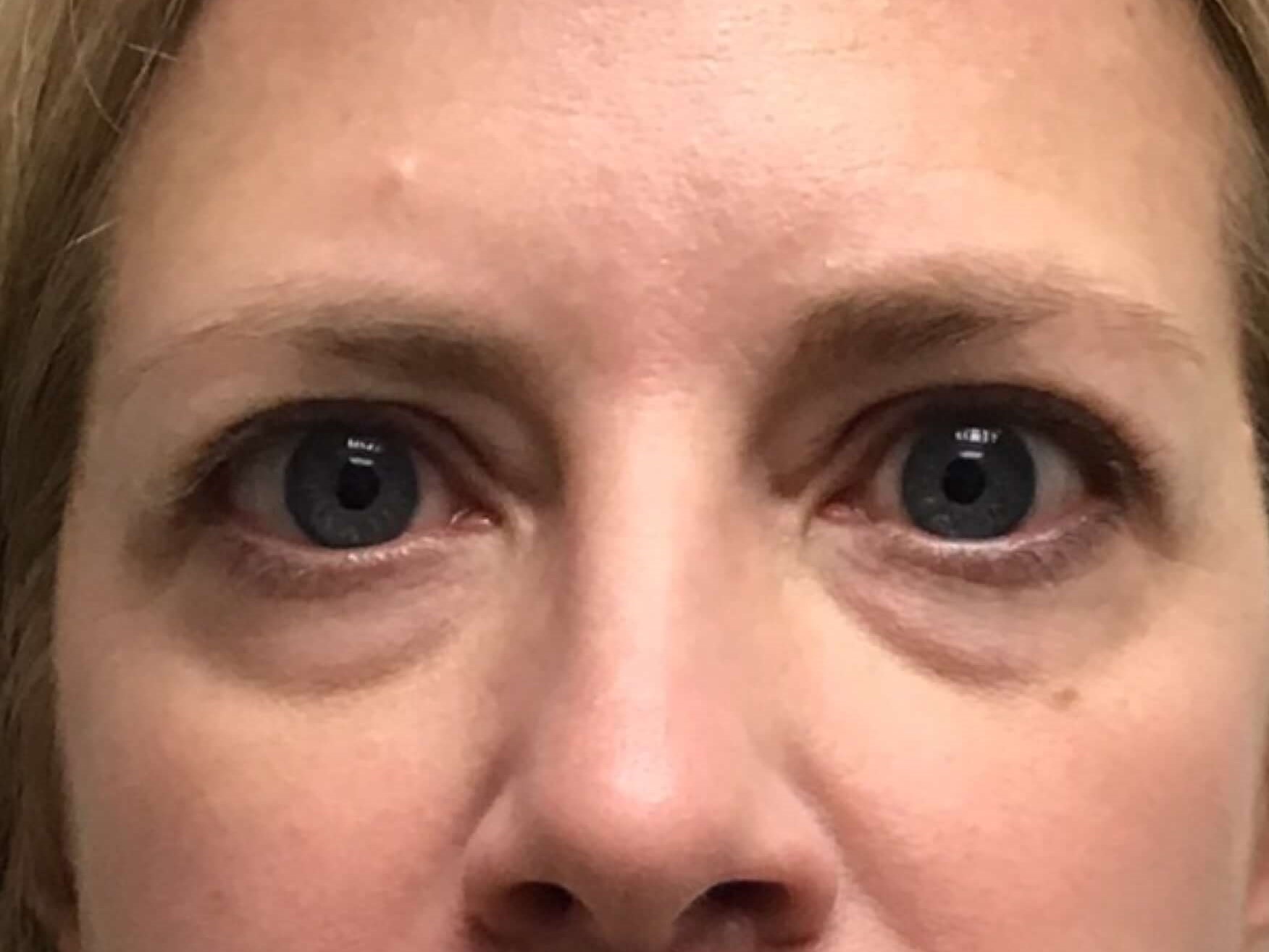 Tear Trough Filler Before