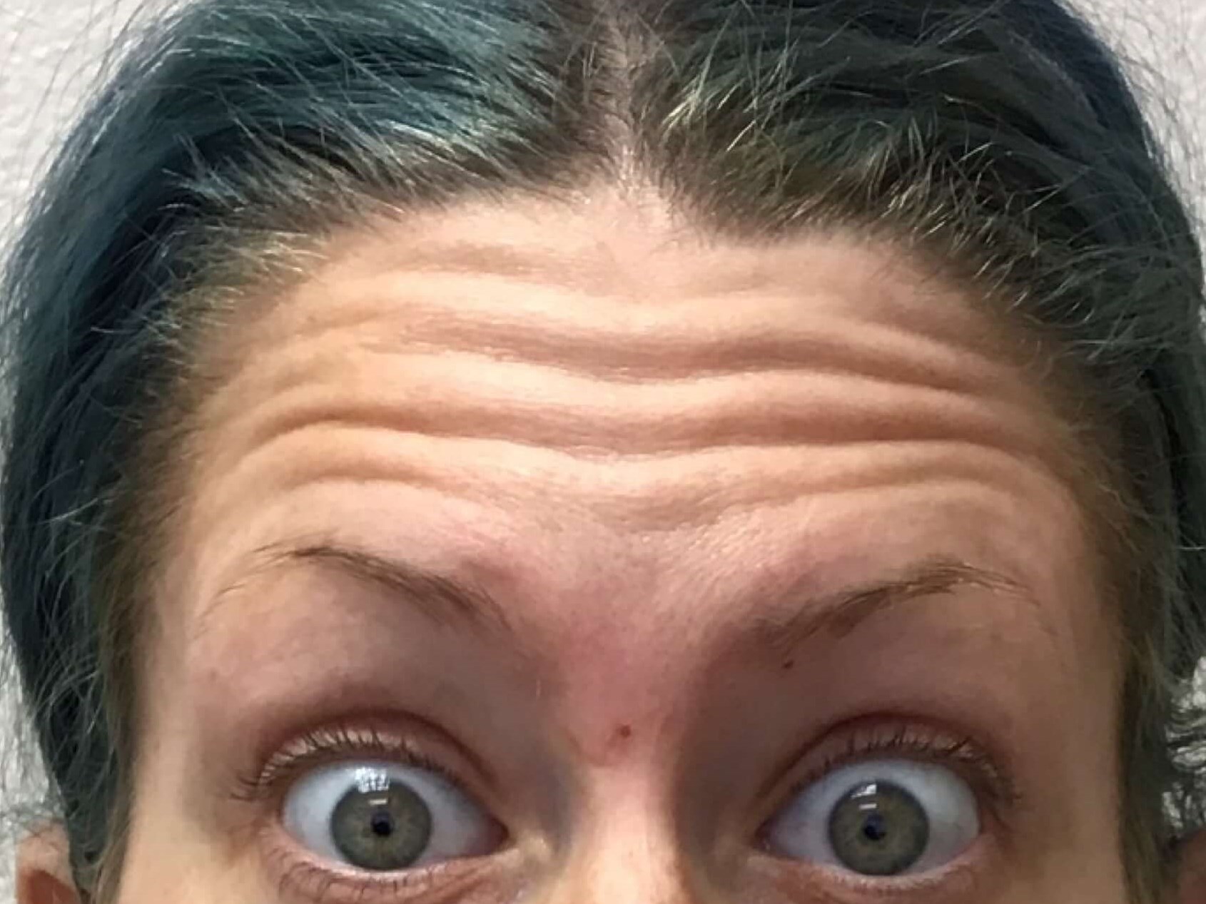 Botox for Forehead Lines Before