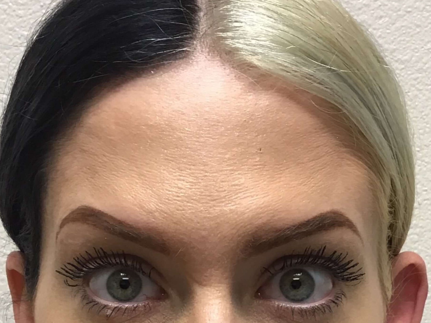 Botox for Forehead Lines After
