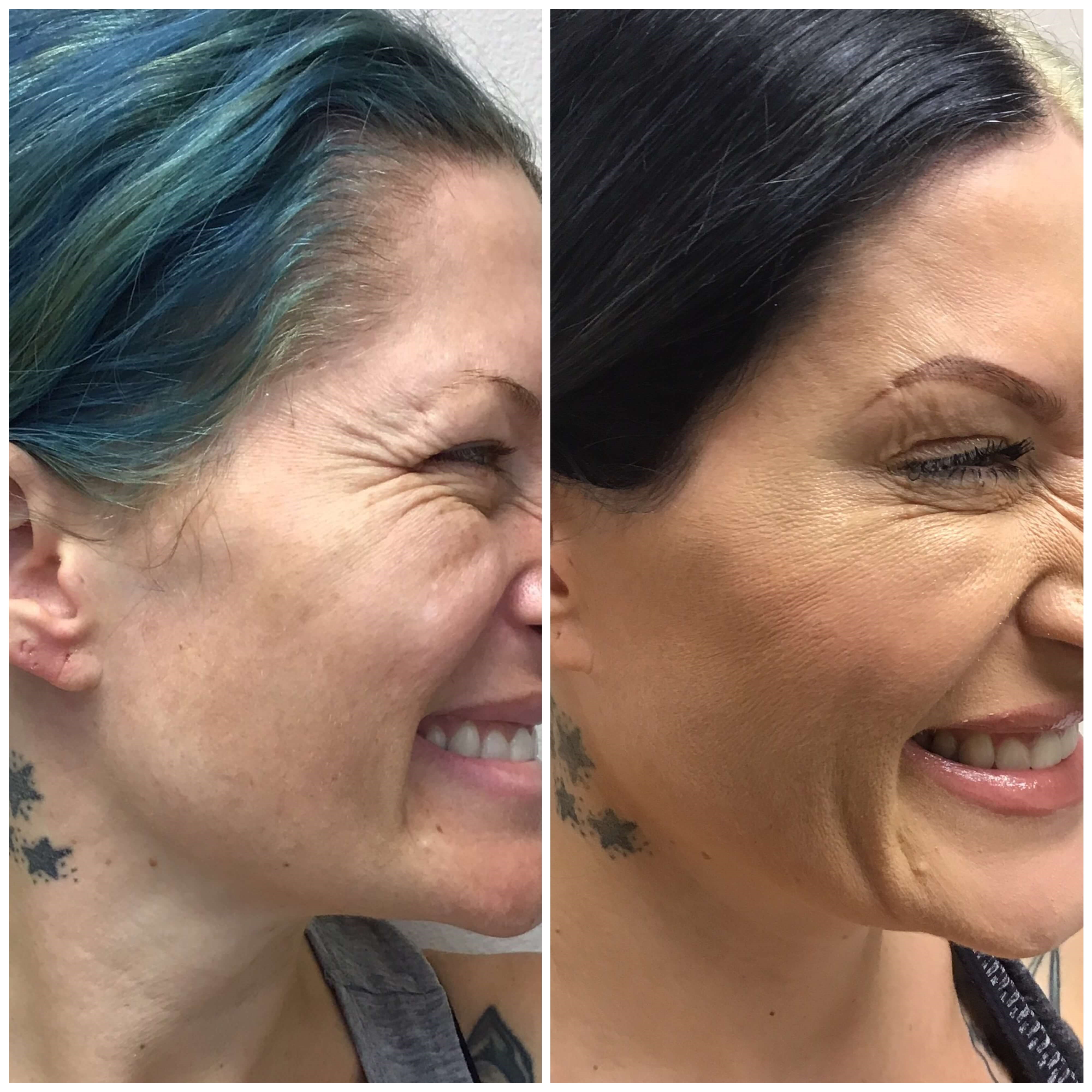 Botox for Crow's Feet Before & After Botox R Eye