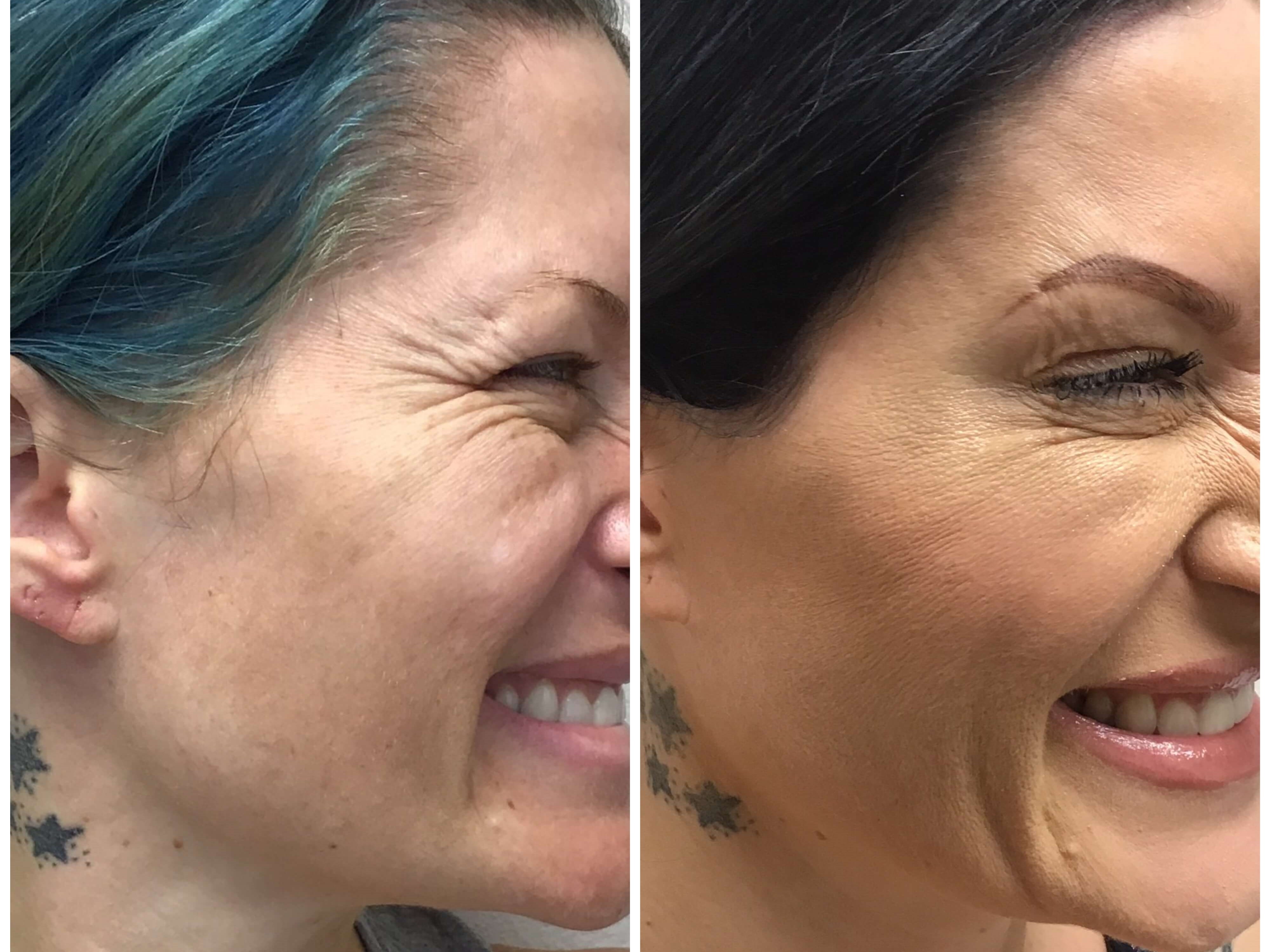 Botox for Crow's Feet Before & After Botox R Eye