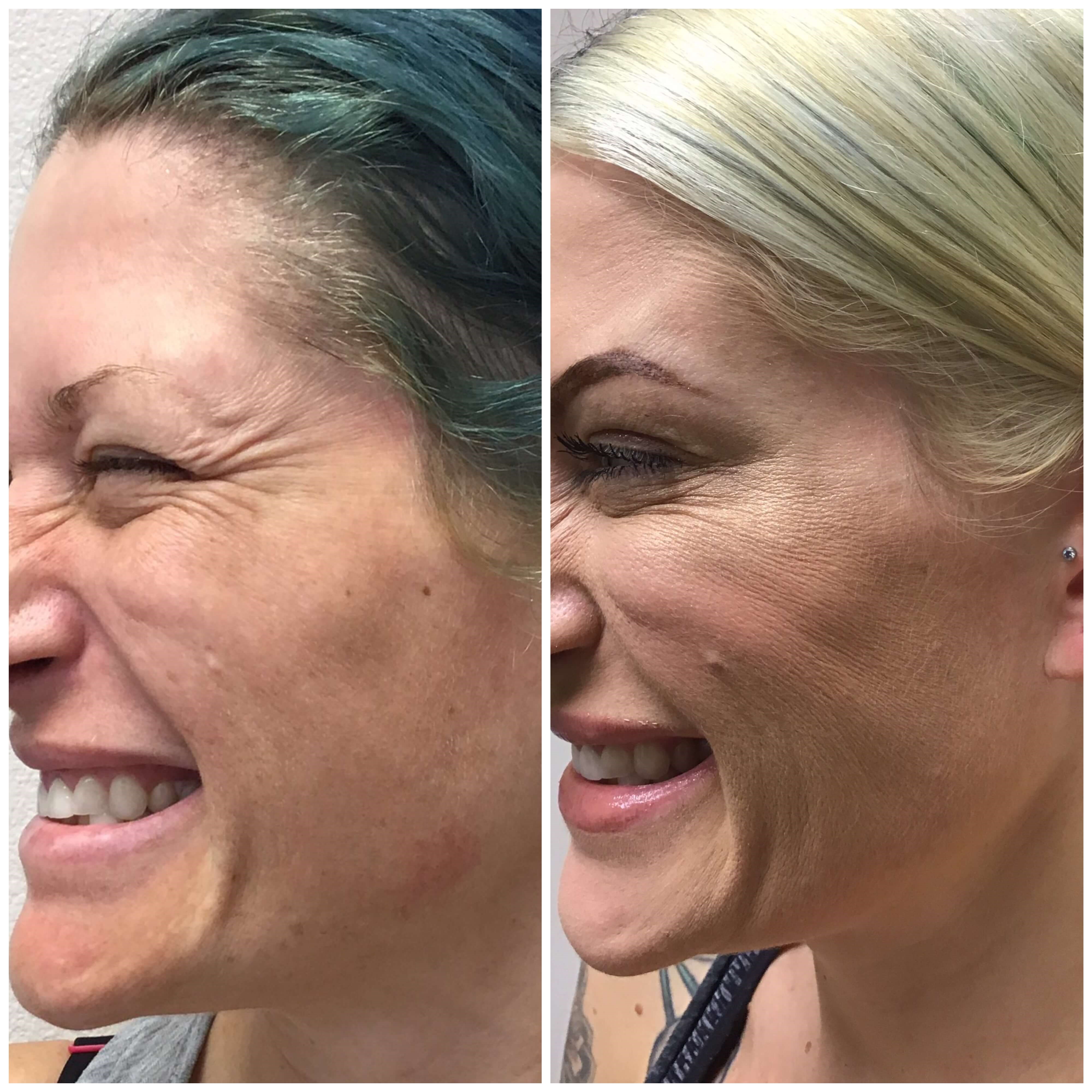 Botox for Crow's Feet Before & After Botox L Eye