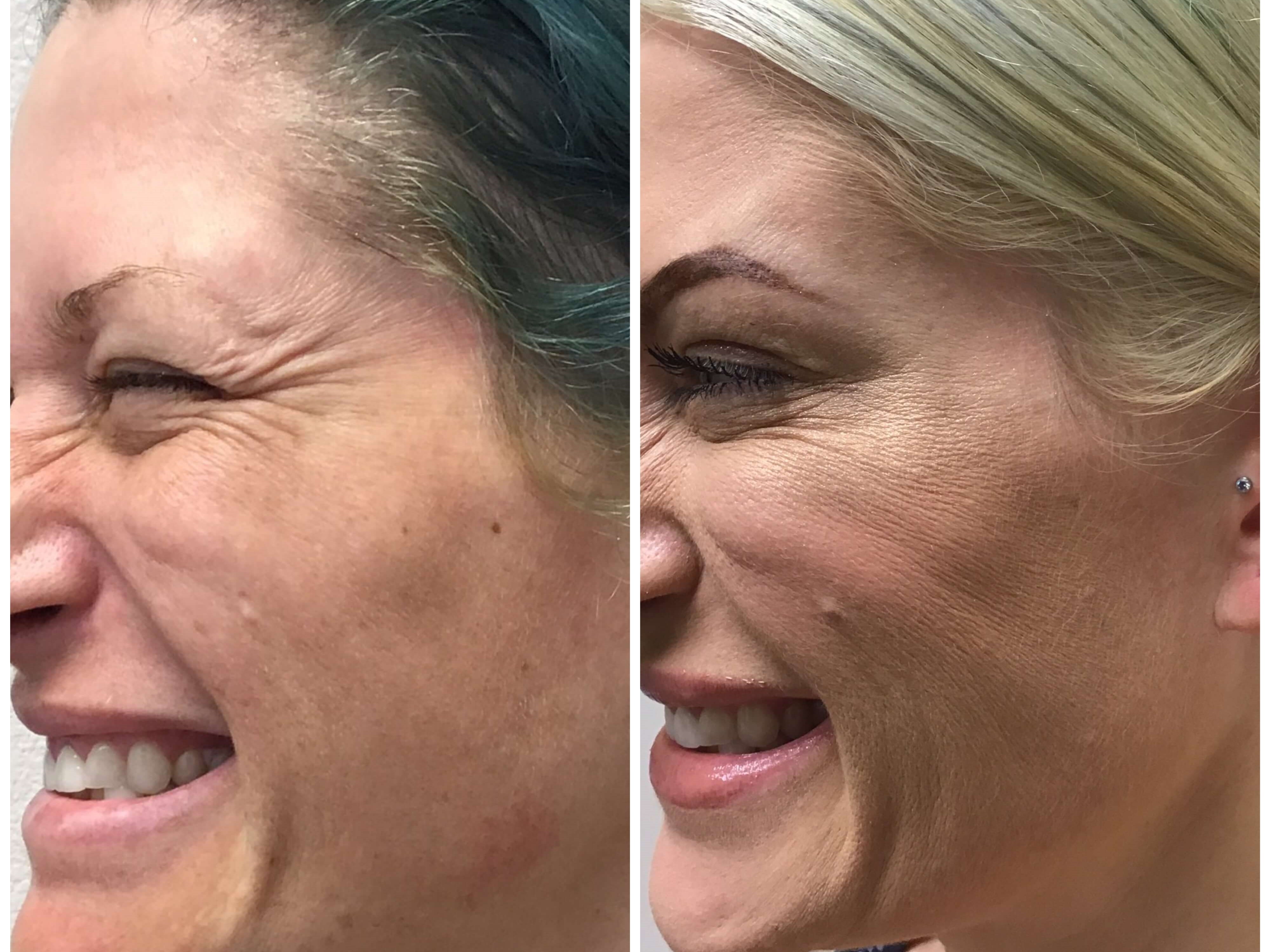 Botox for Crow's Feet Before & After Botox L Eye