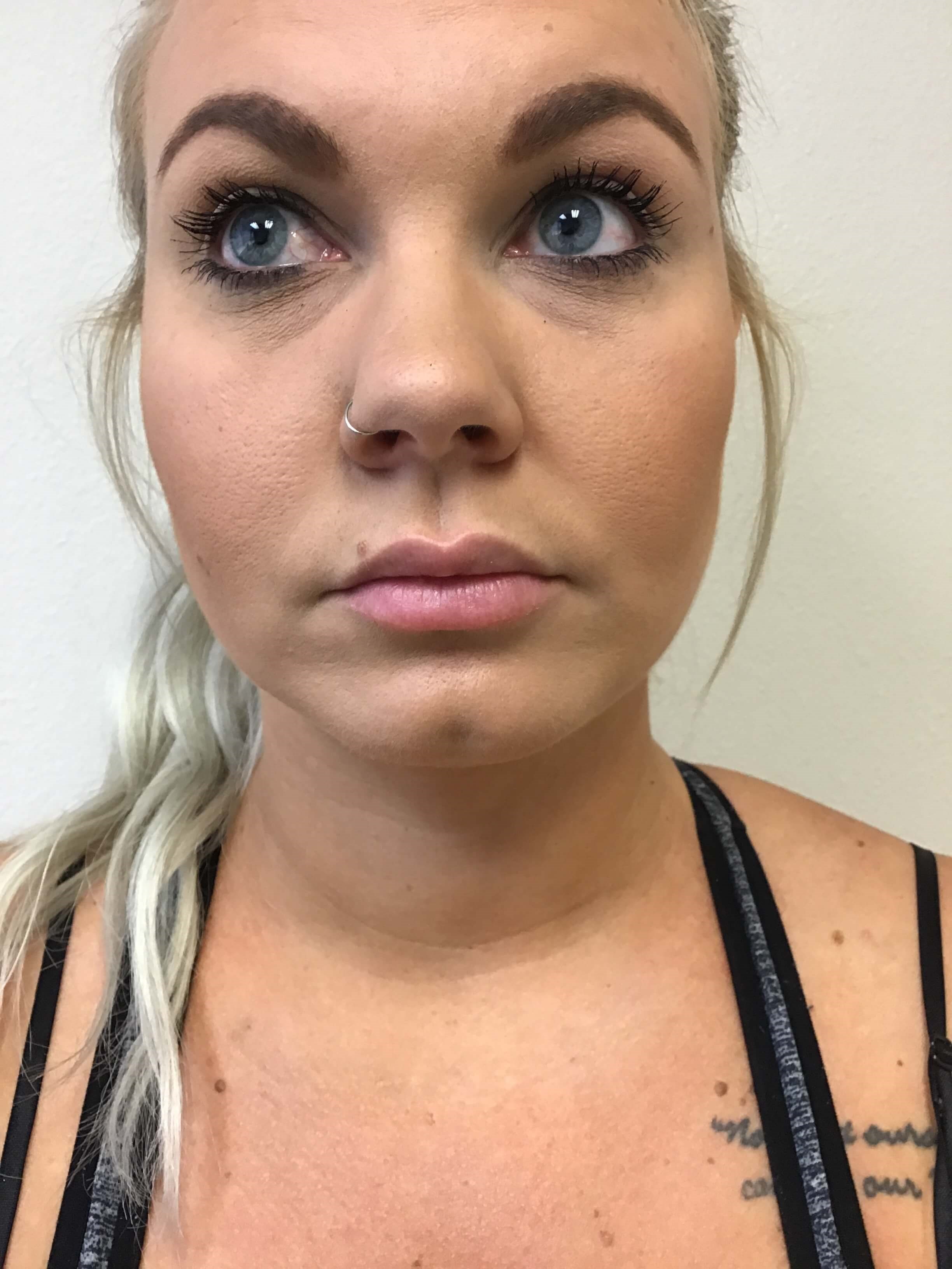 1 mL of Juvederm Ultra Plus Before