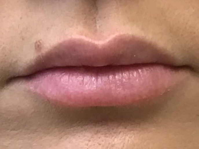 1 mL of Juvederm Ultra Plus Before