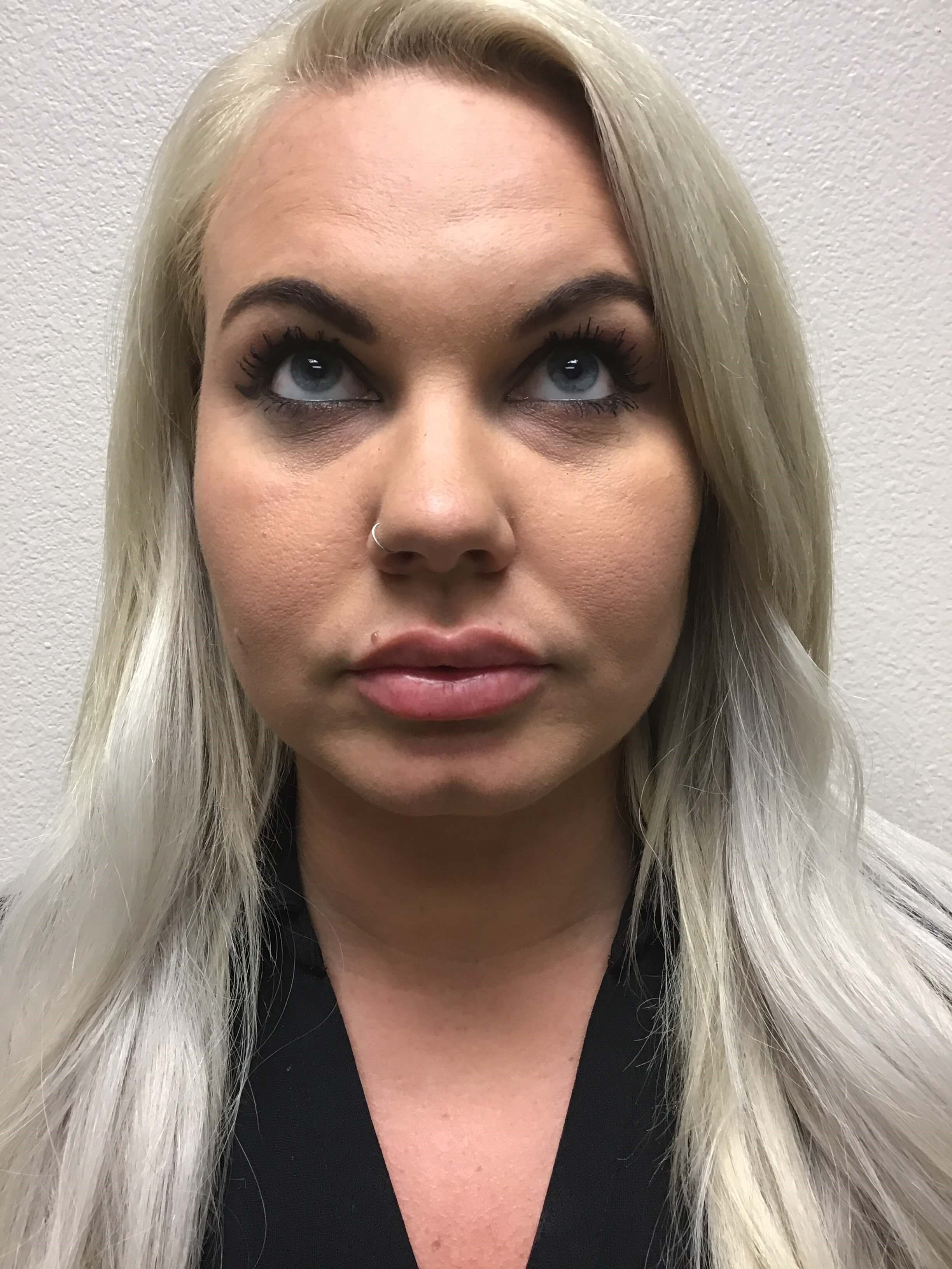 1 mL of Juvederm Ultra Plus After