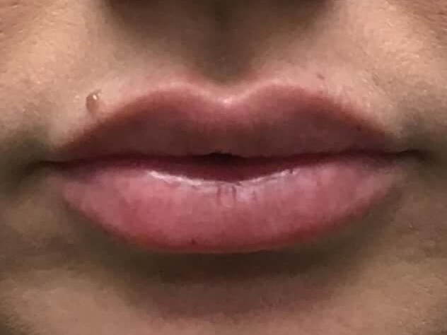 1 mL of Juvederm Ultra Plus After