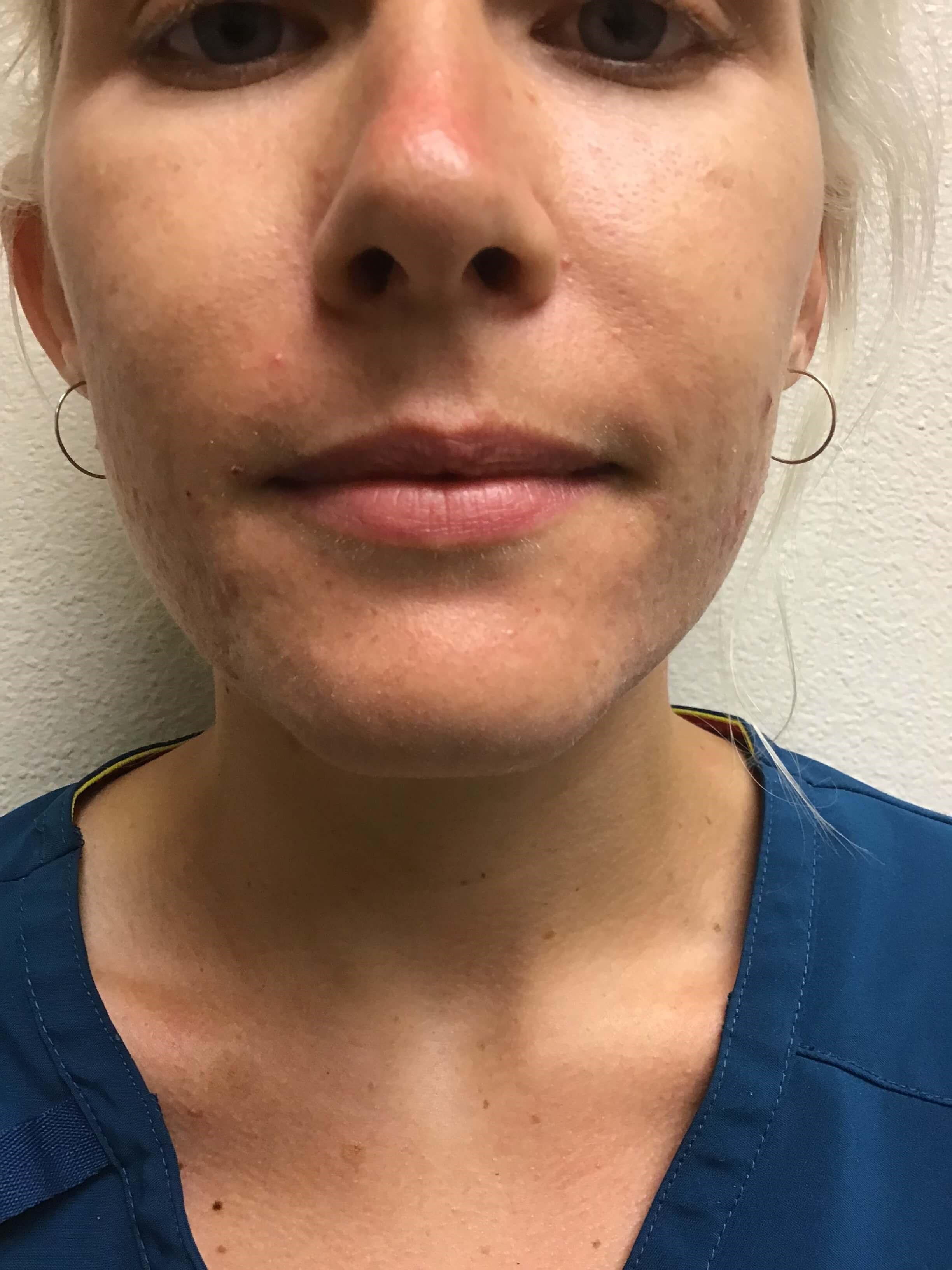 Before and After Lip Filler Before