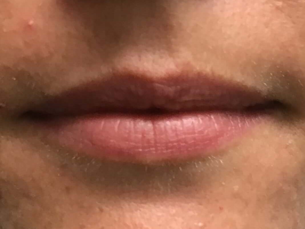 Before and After Lip Filler Before