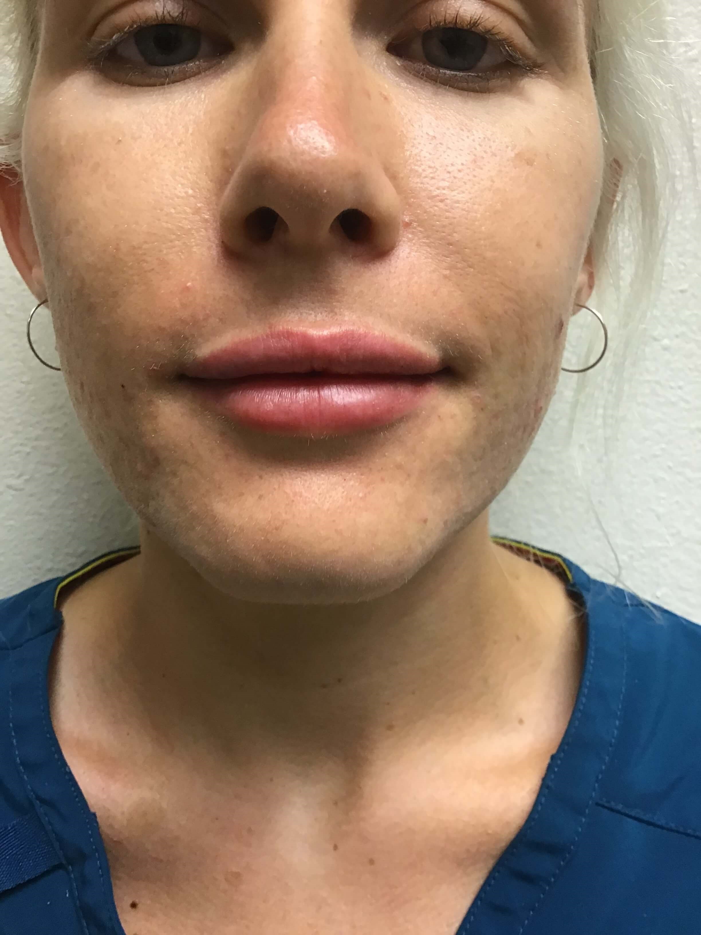 Before and After Lip Filler After