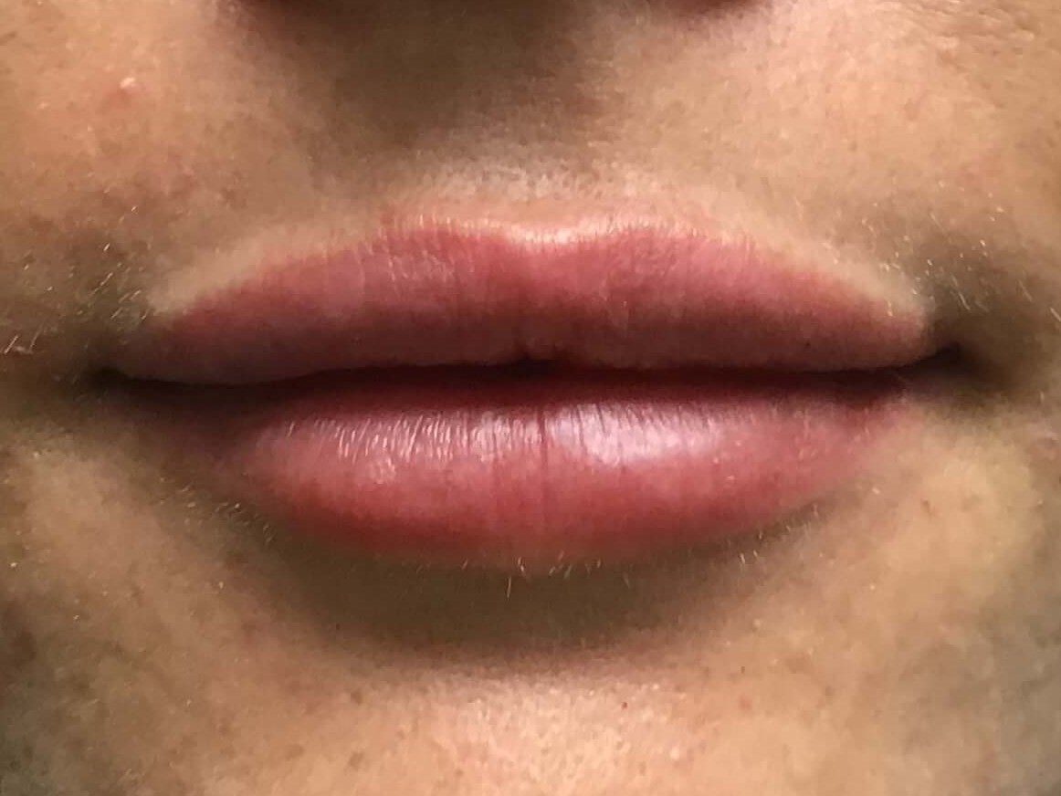 Before and After Lip Filler After