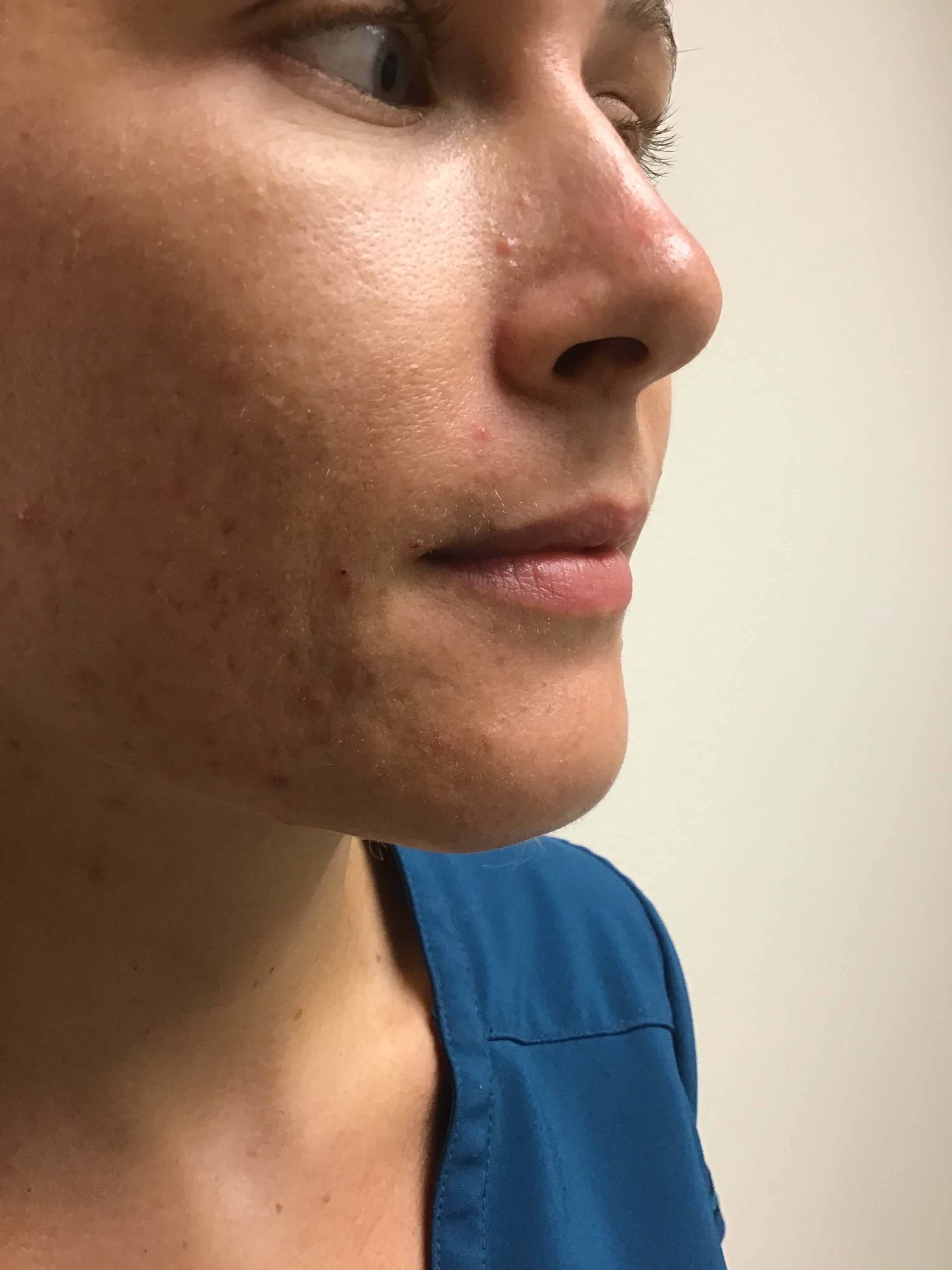 Side View Before and After Before