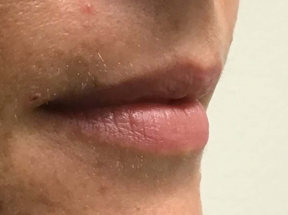 Side View Before and After Before