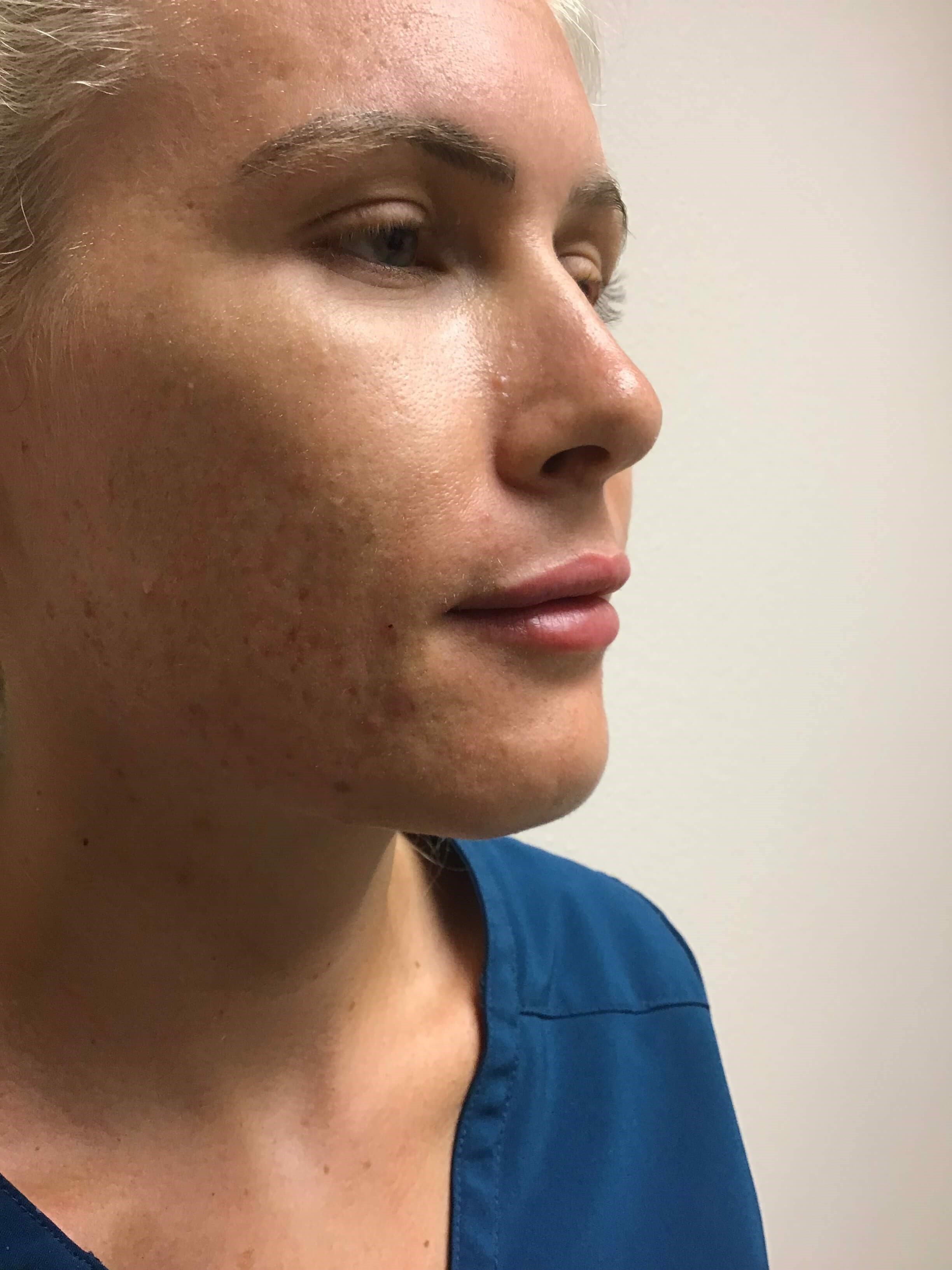 Side View Before and After After