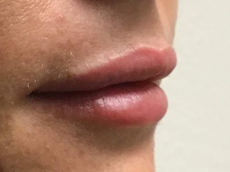 Side View Before and After After