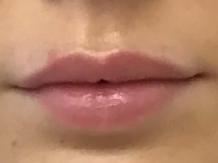 Before and After Lip Filler Before