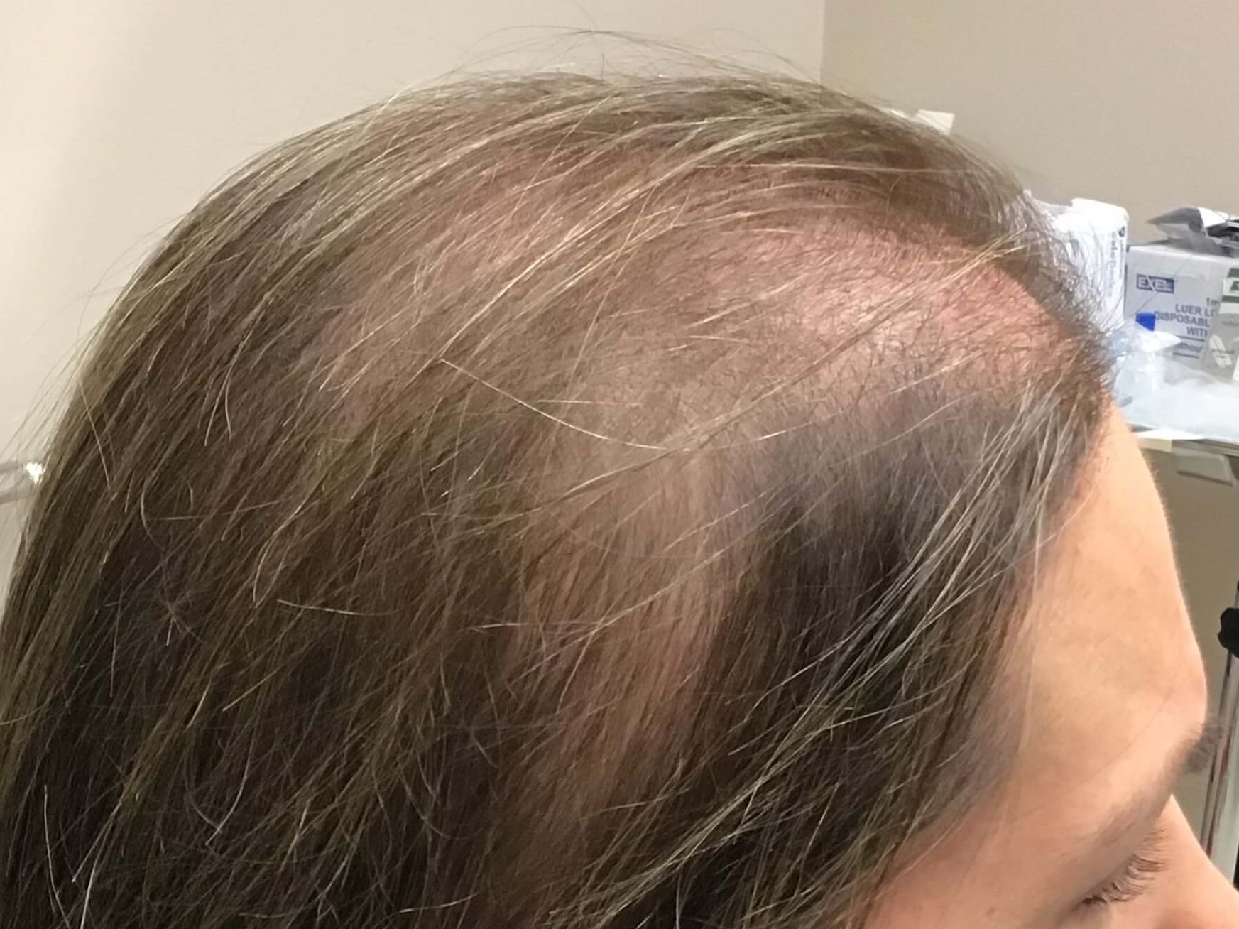 Hair Regrowth Before