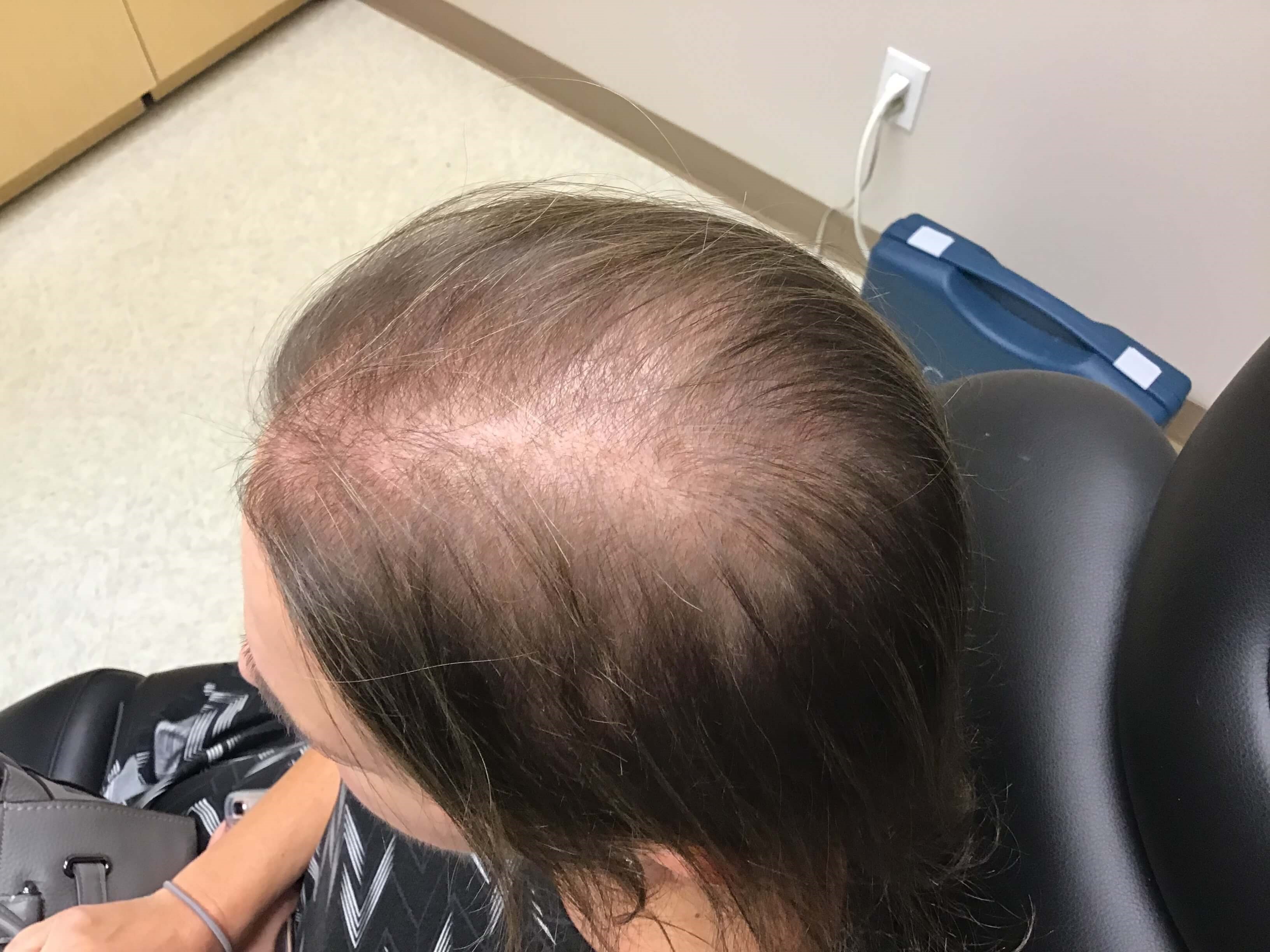 Hair Regrowth Before