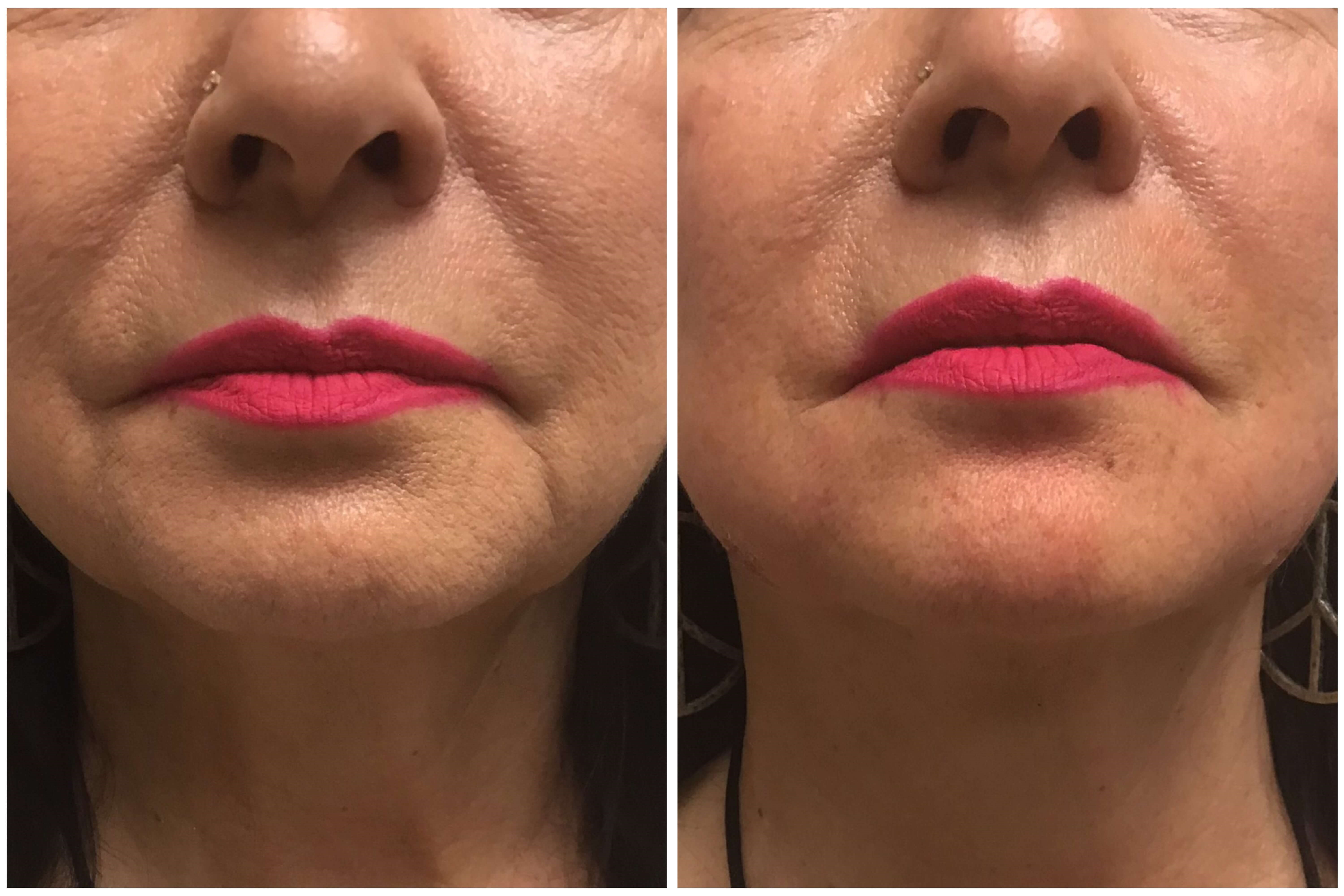 Before and After Filler Before