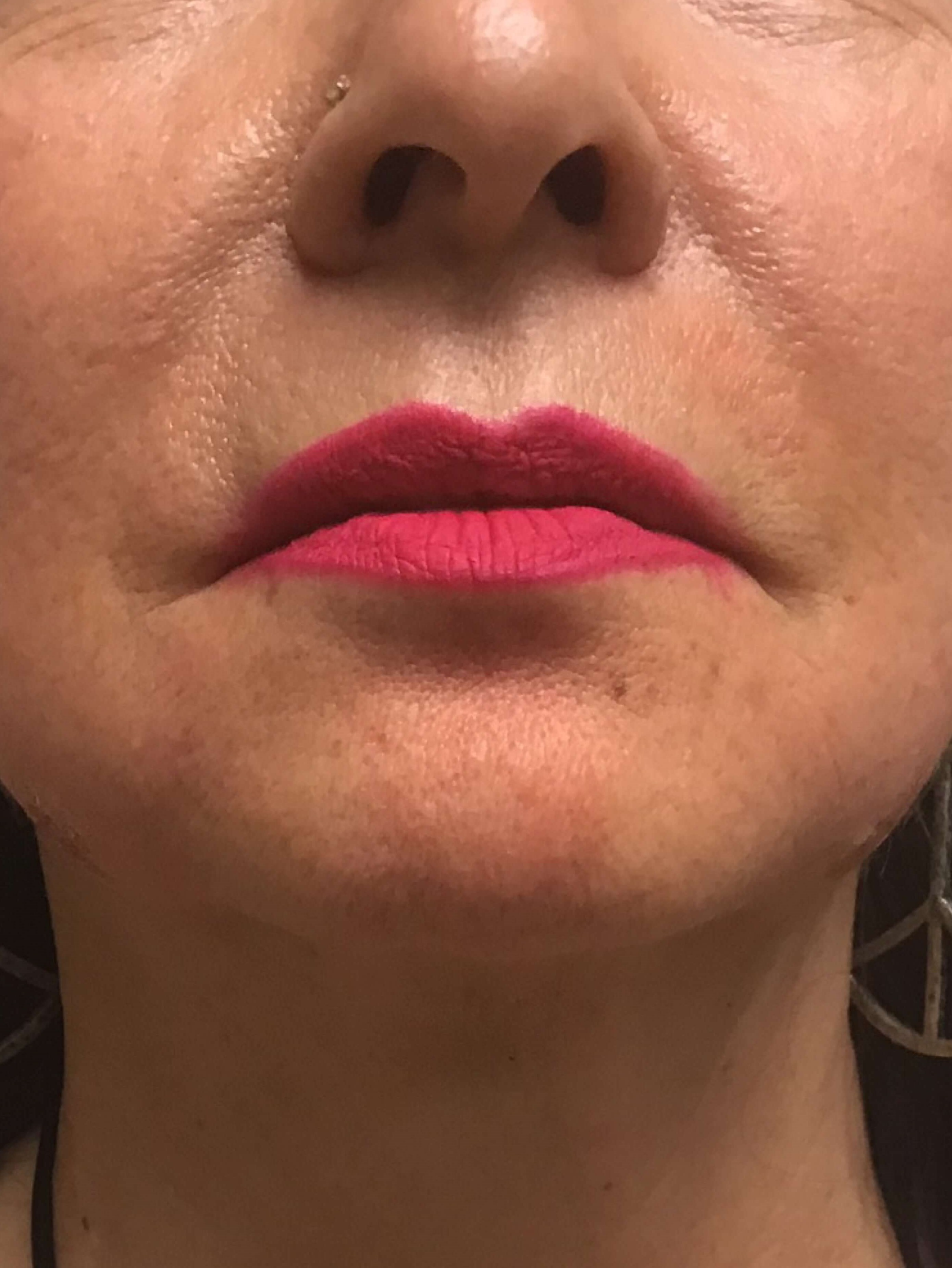 Before and After Filler After