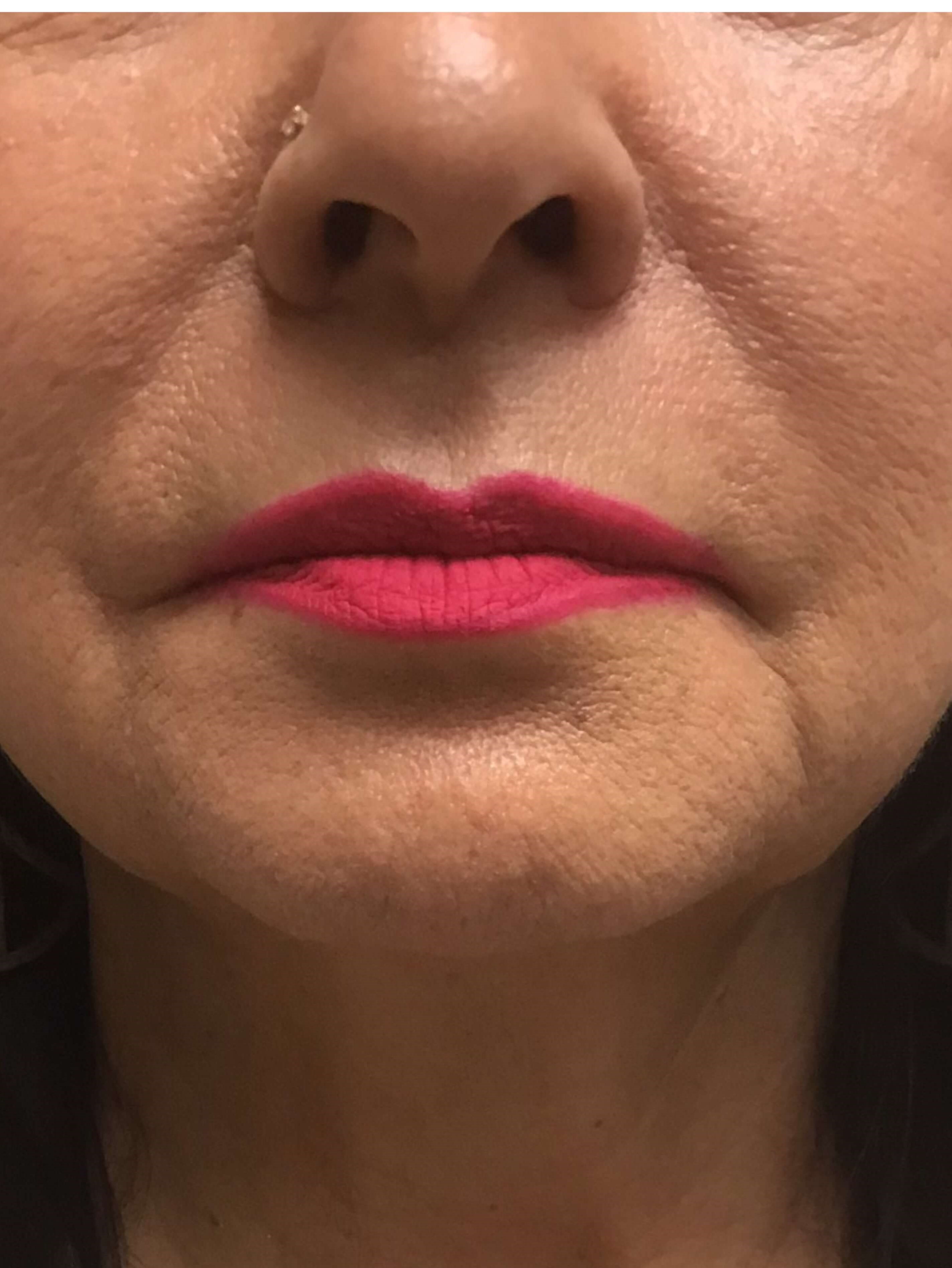 Before and After Filler Before