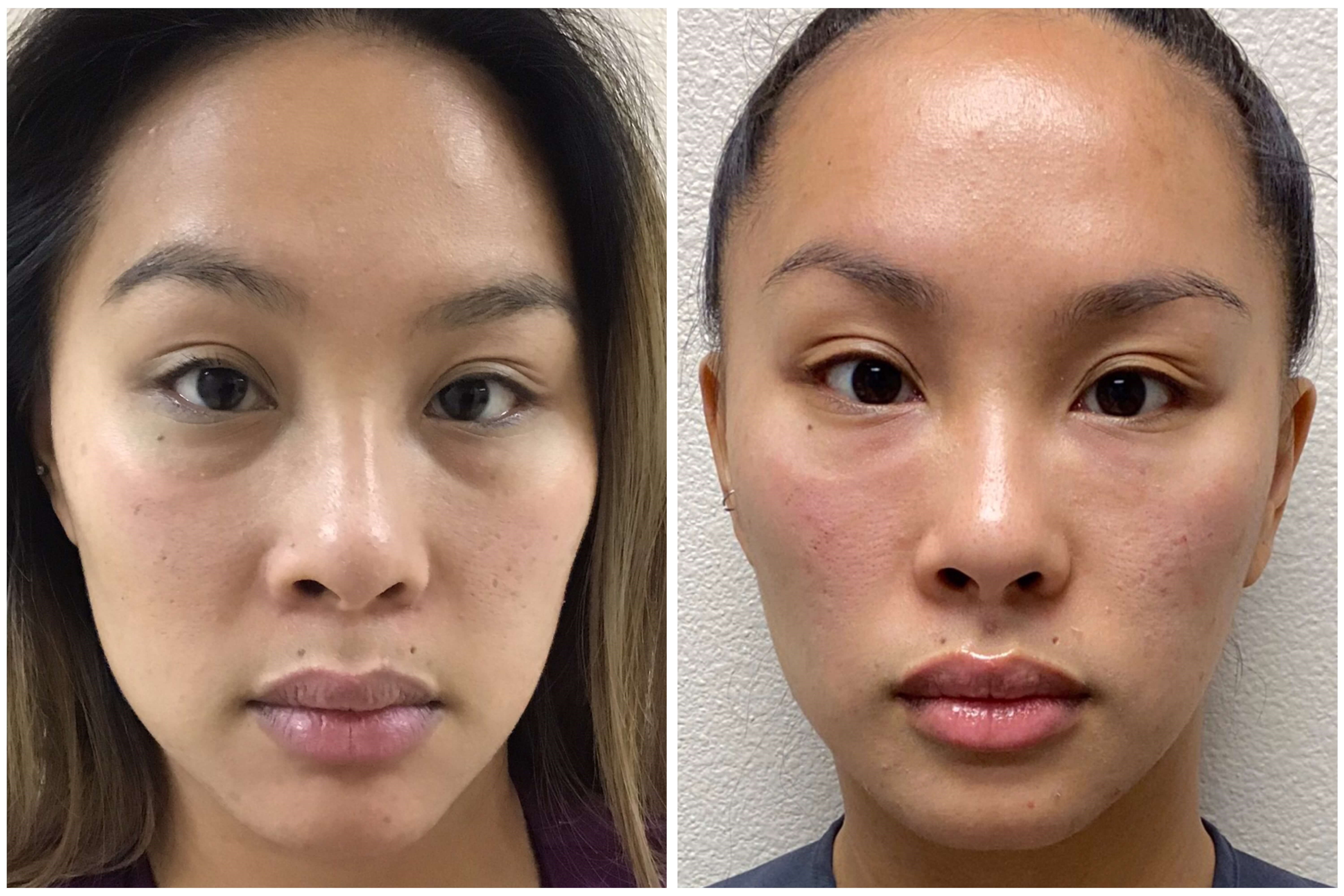 Before and After Filler Before