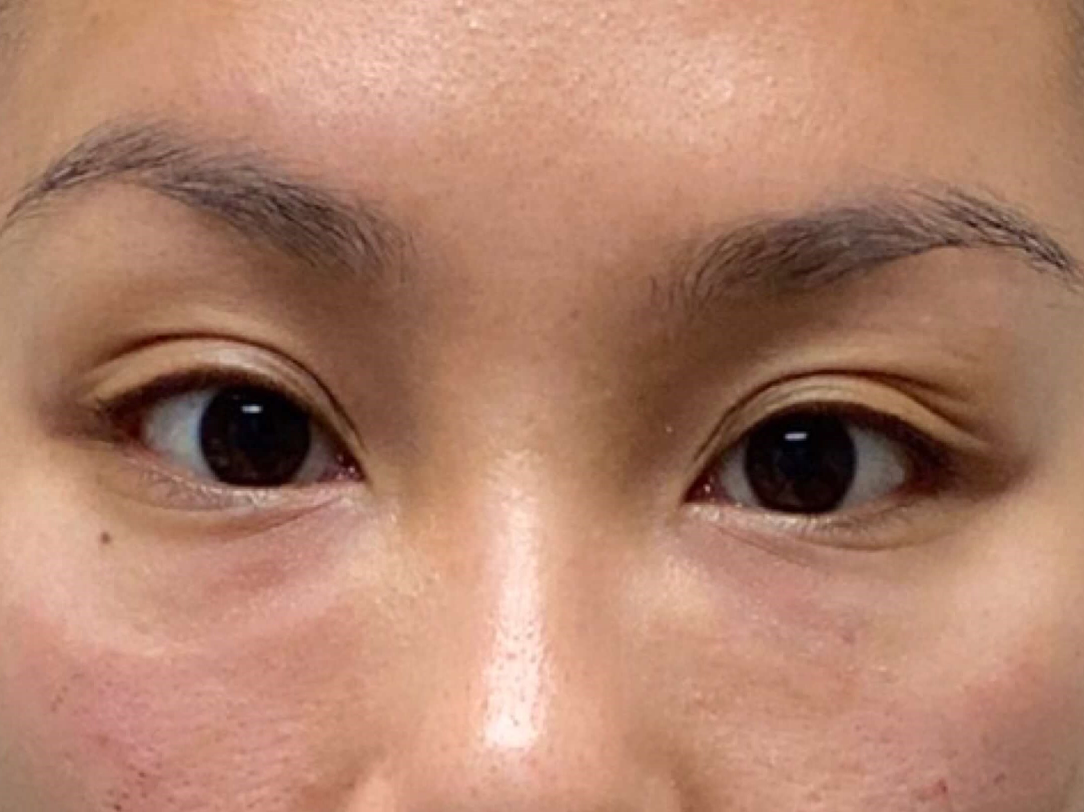 Before and After Filler After