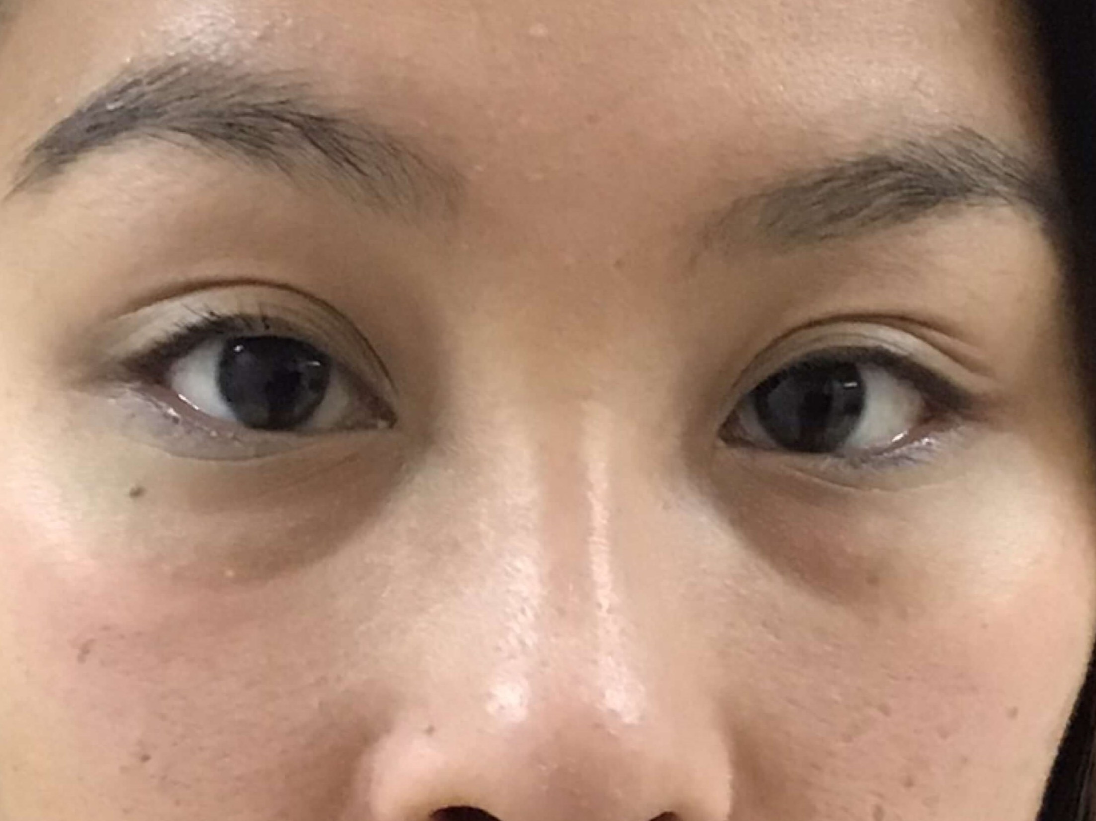 Before and After Filler Before