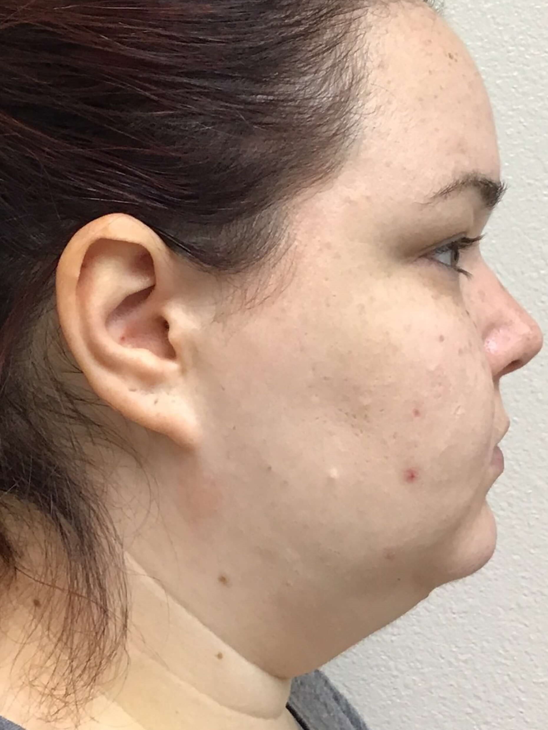 Before and After Liposuction Before