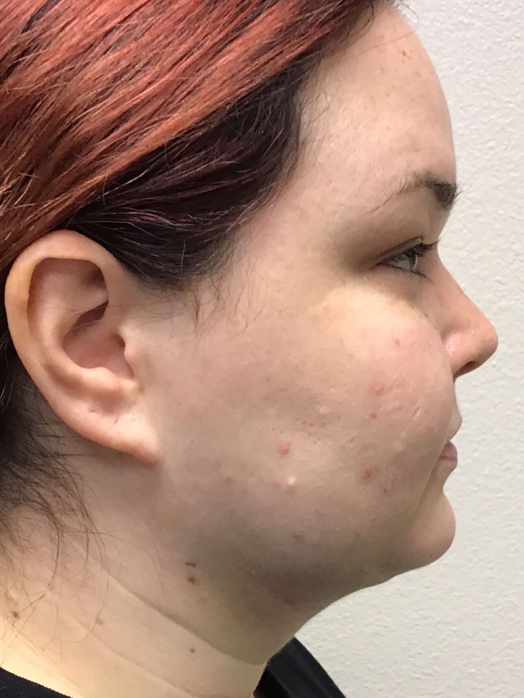 Before and After Fat Transfer & Laser Lipo Photos