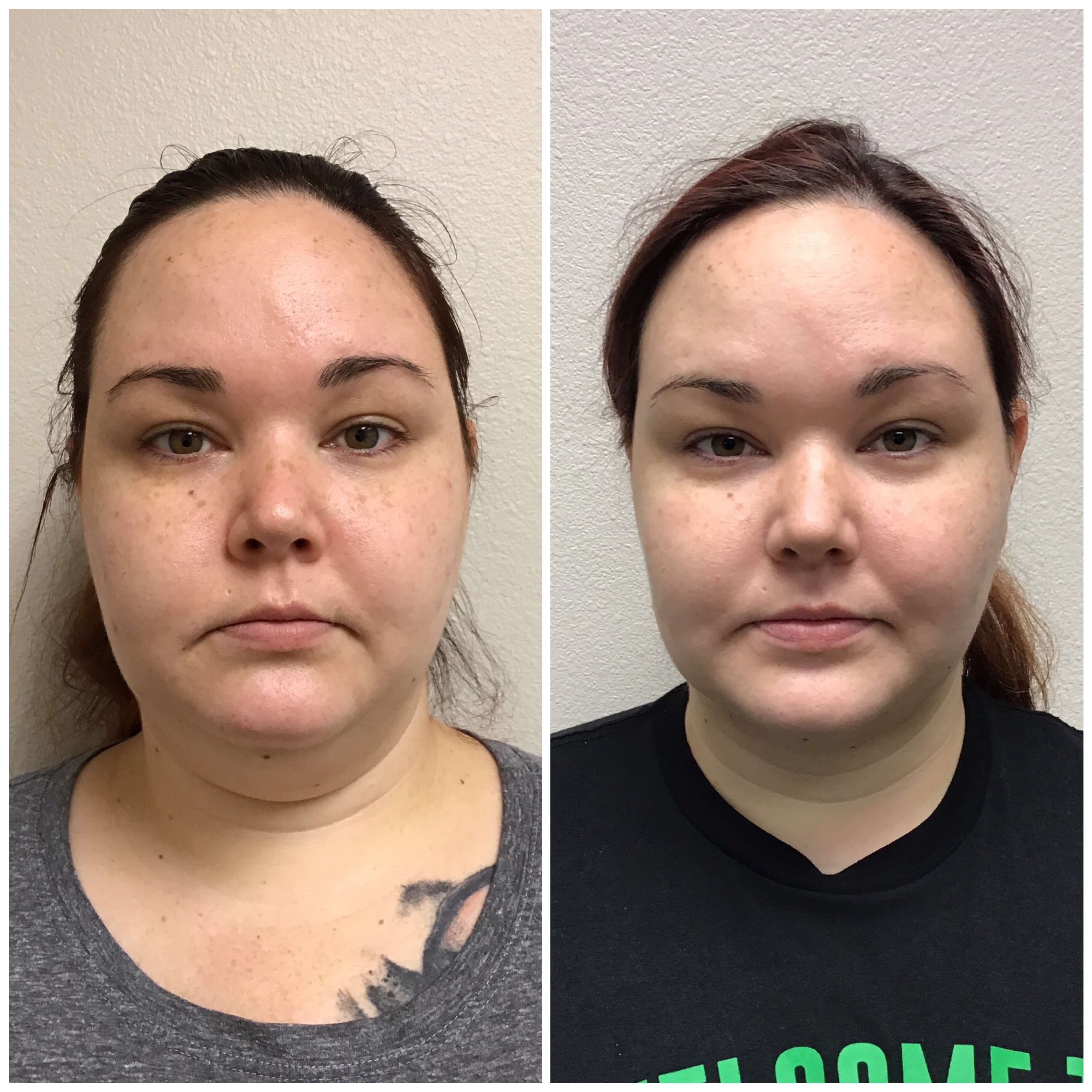 Before and After Liposuction Before