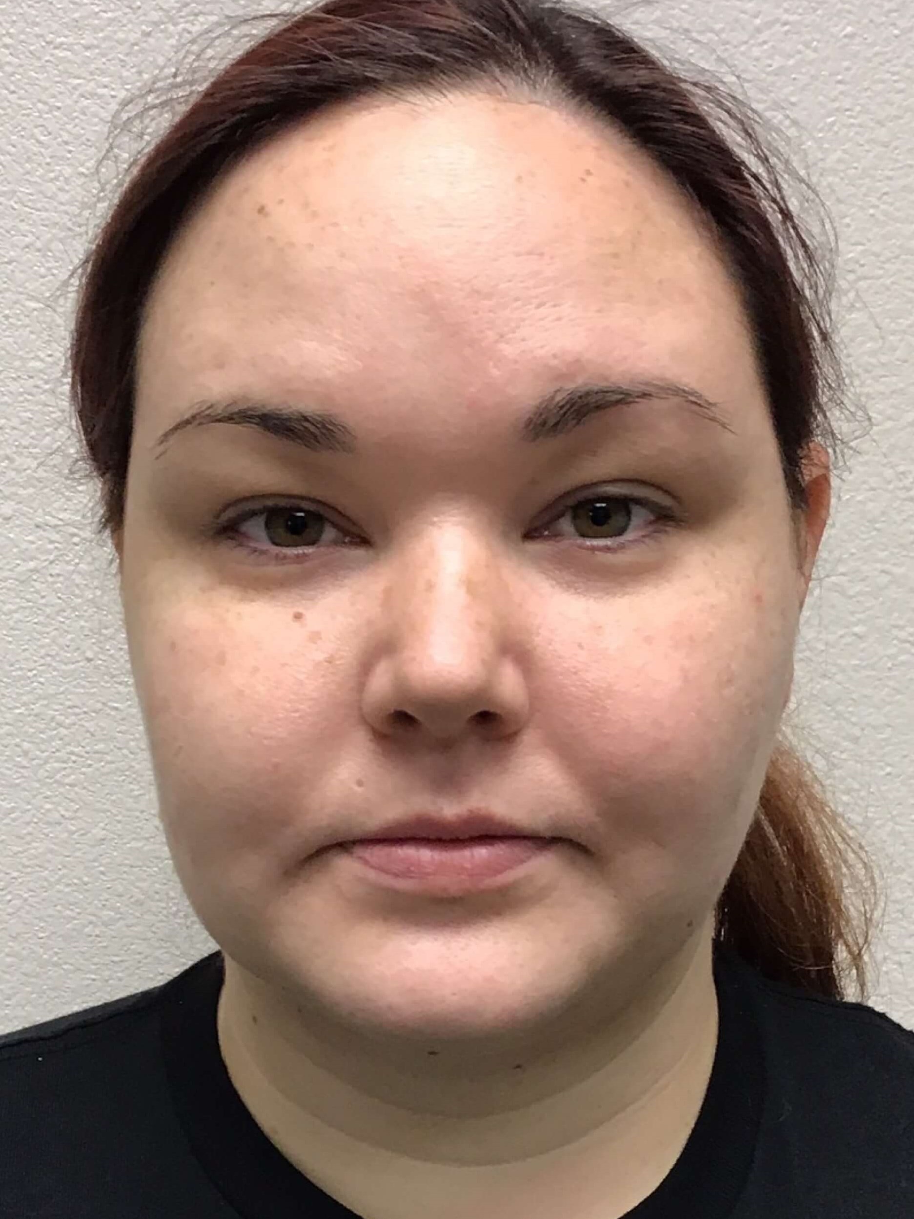 Before and After Liposuction After