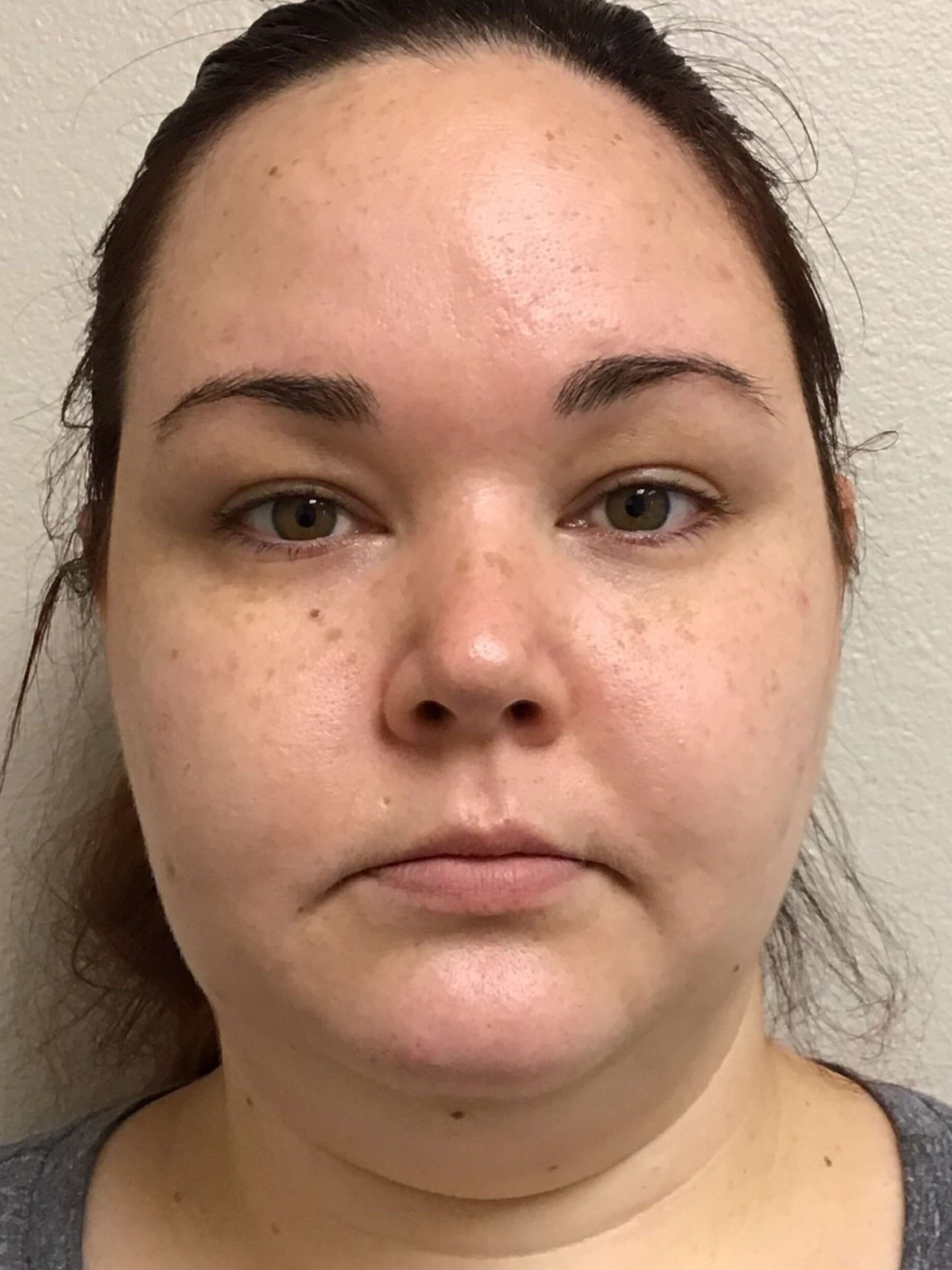 Before and After Liposuction Before