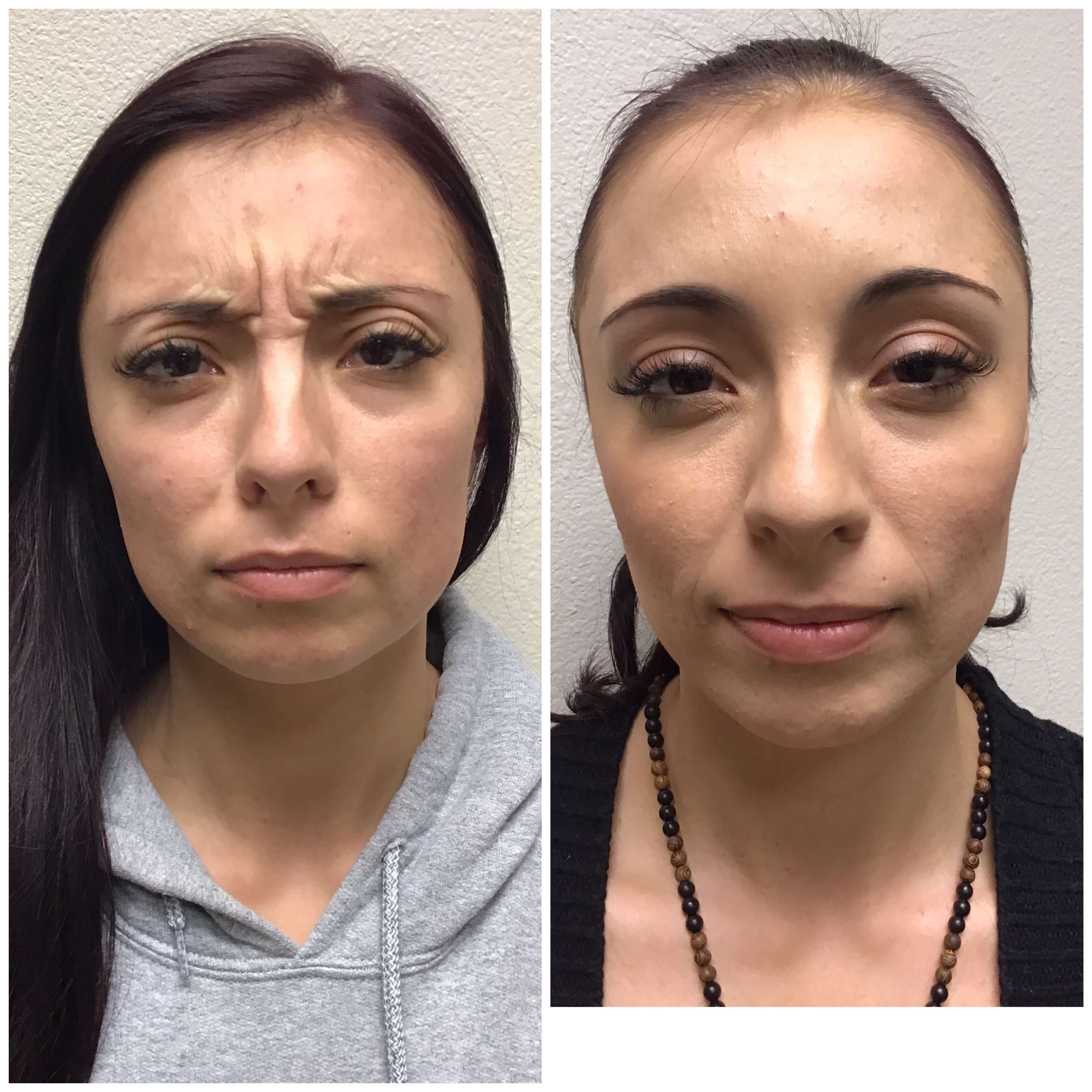 Before and After Botox Before