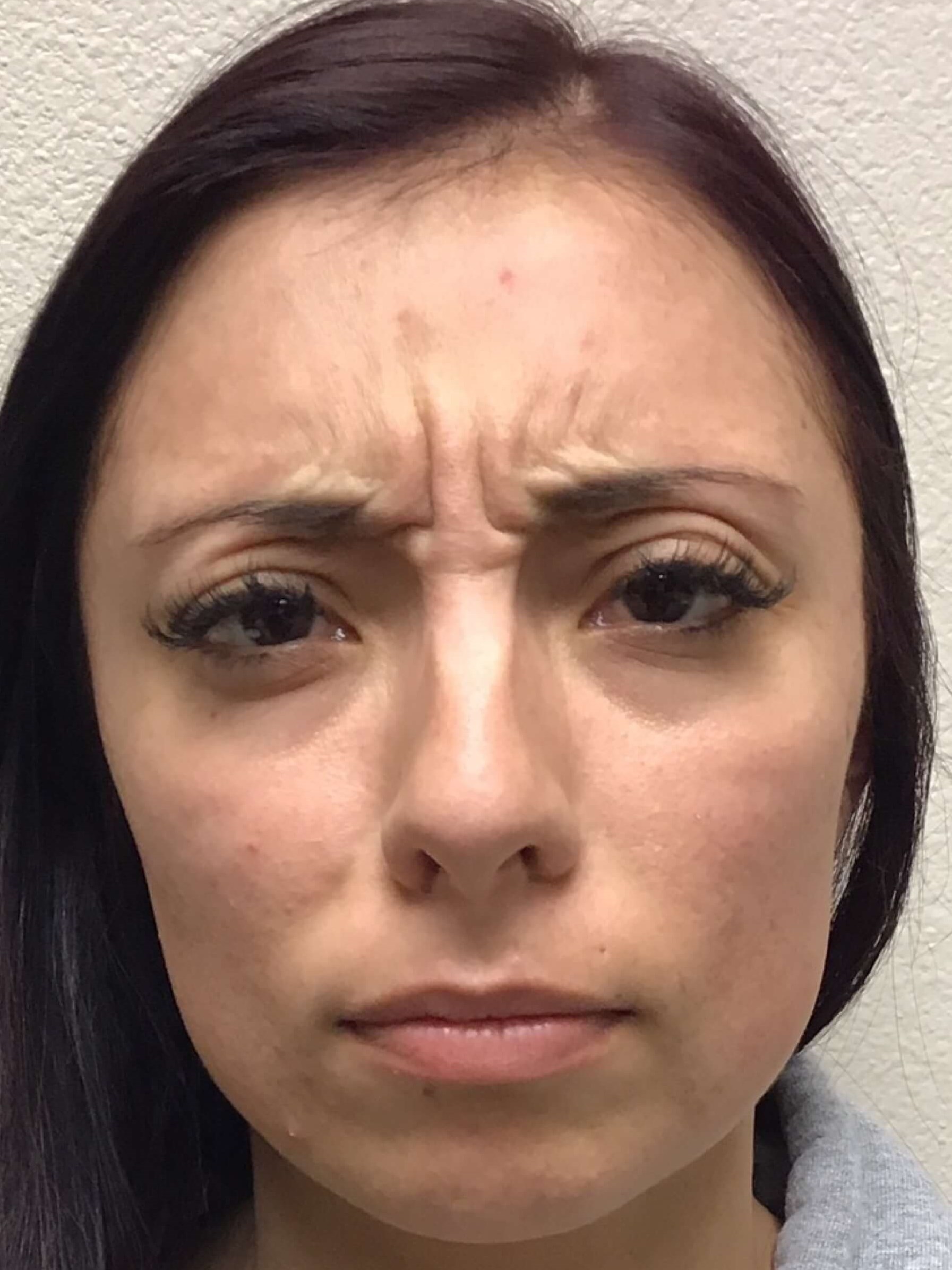 Before and After Botox Before