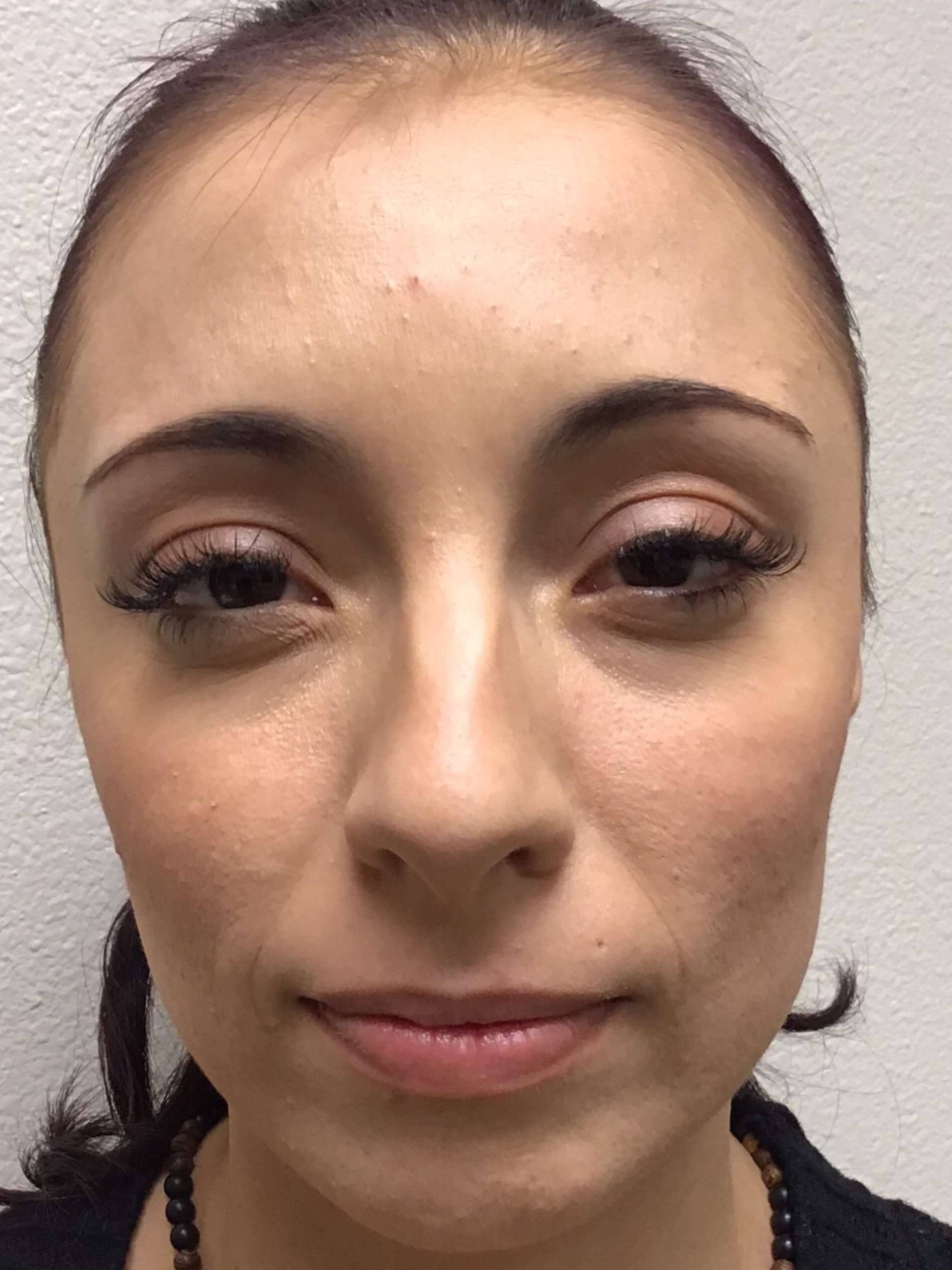 Before and After Botox After