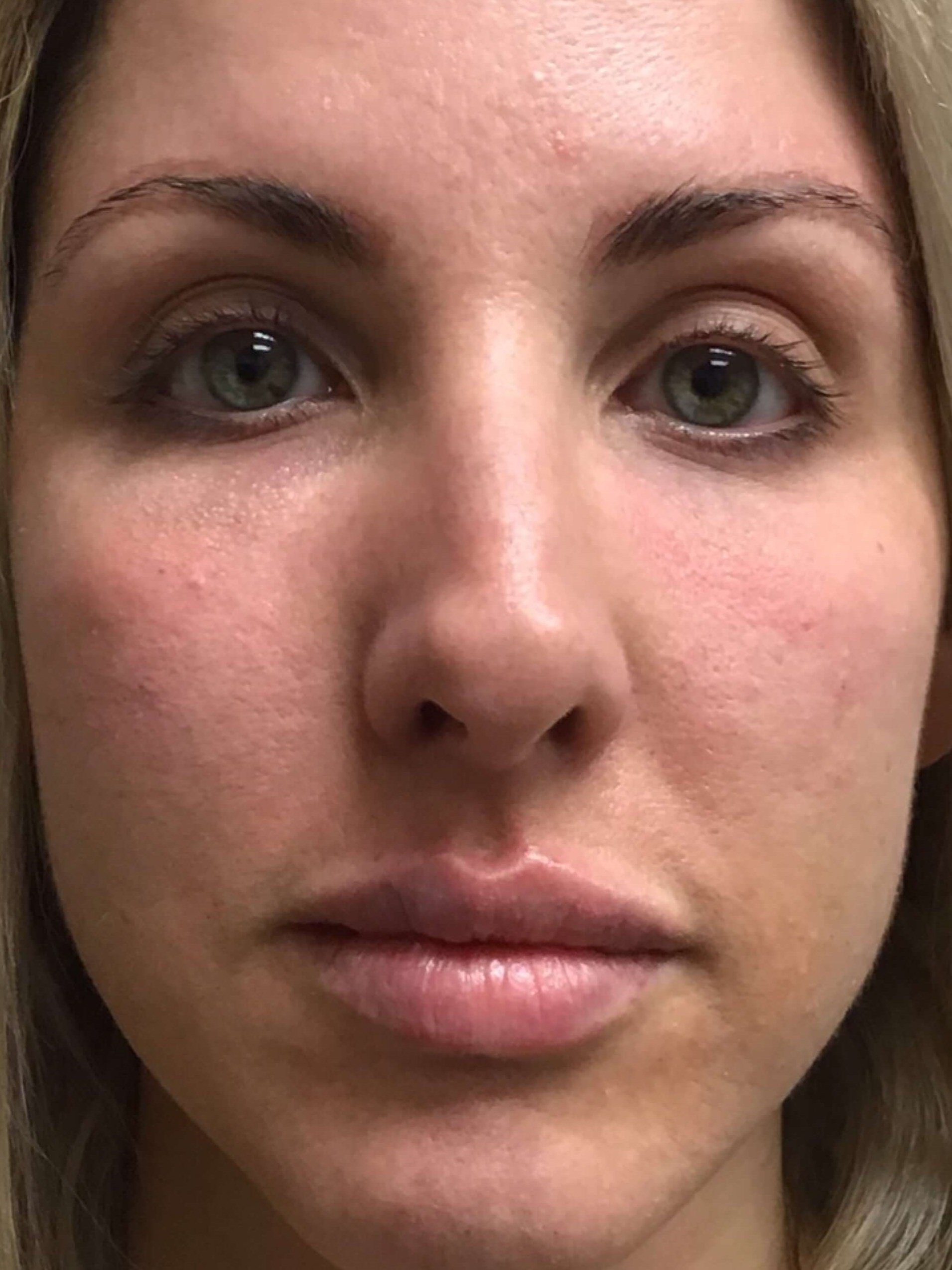 Before & After Dermal Filler After