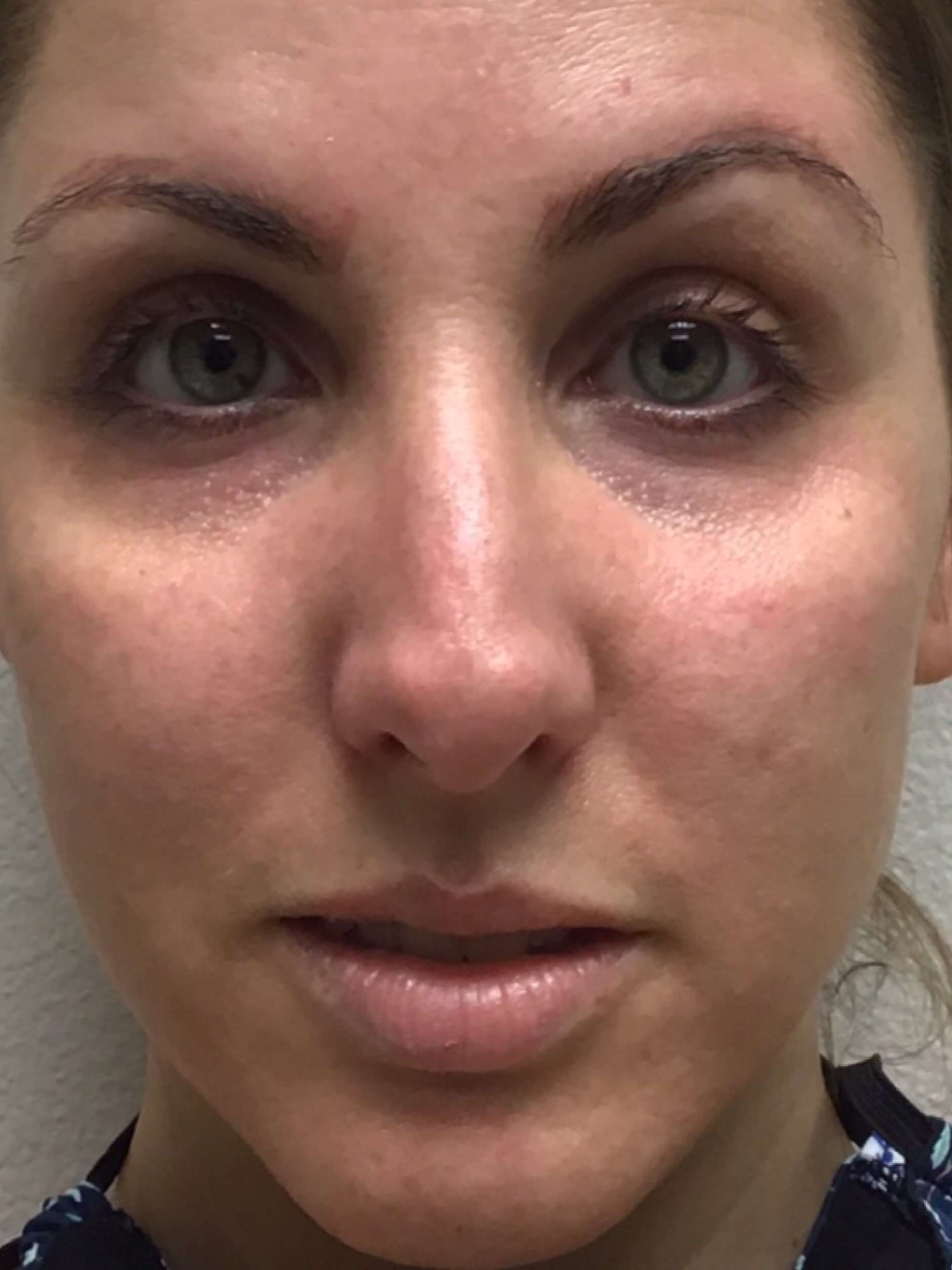 Before & After Dermal Filler Before