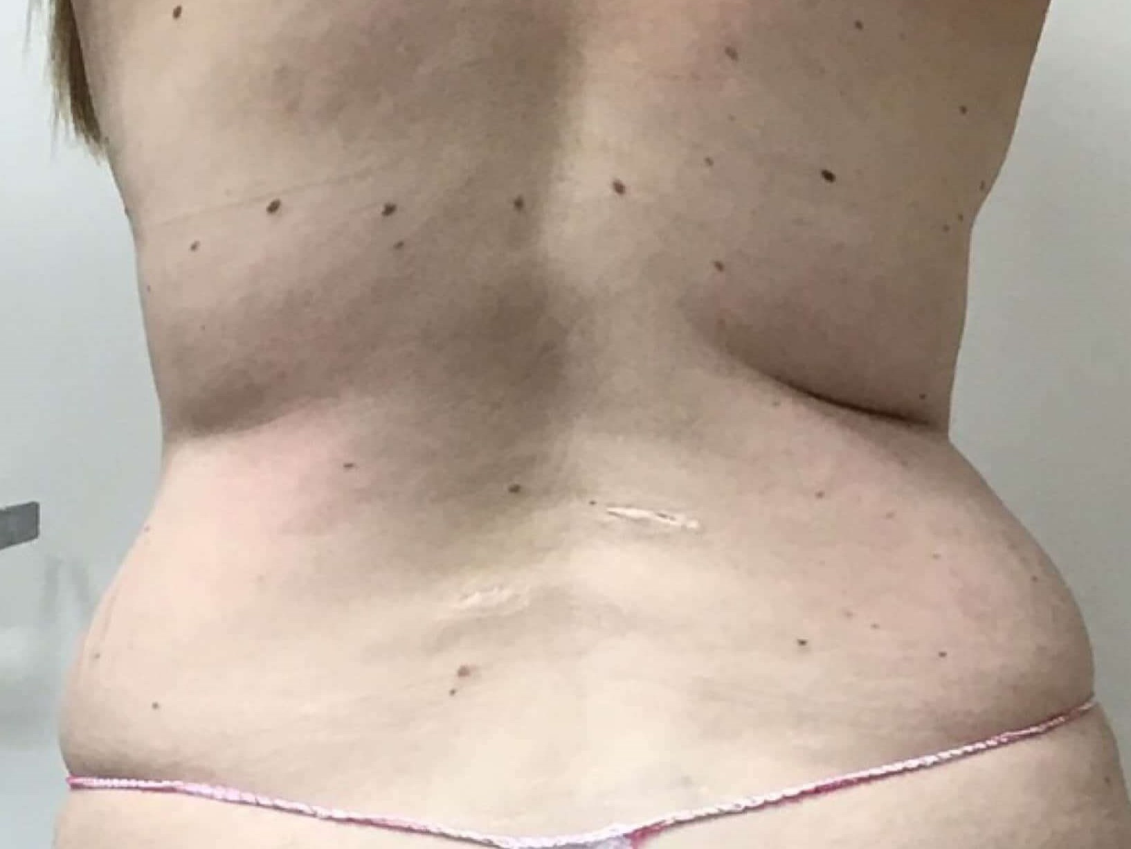 Before & After Liposuction Before