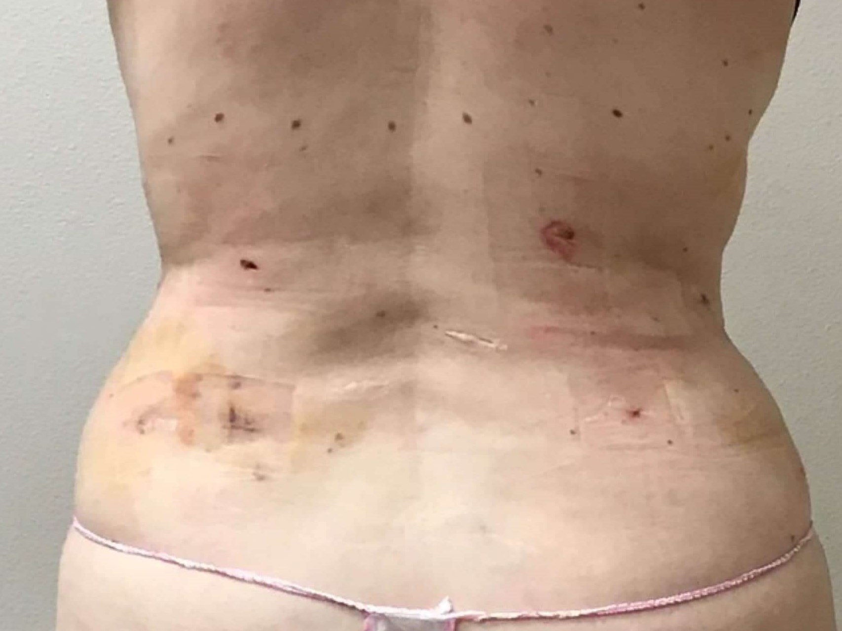 Before & After Liposuction After