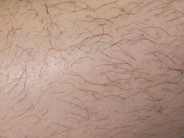 Before & After LHR Before