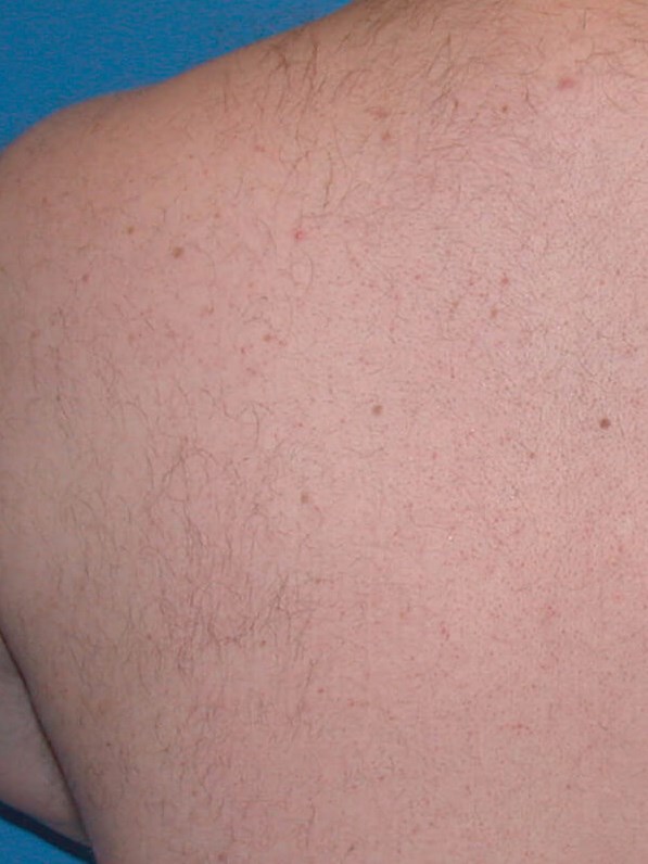 Before and After LHR After