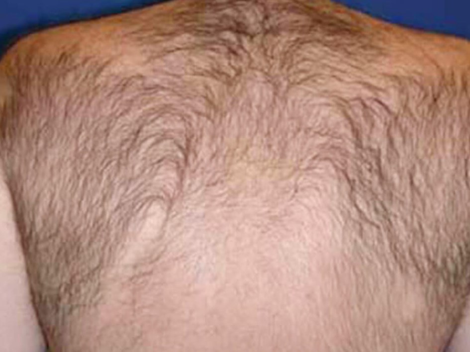 Before and After LHR Before