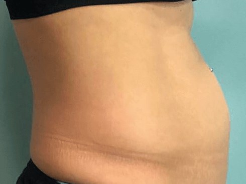 Before and After TruSculpt 3D Before